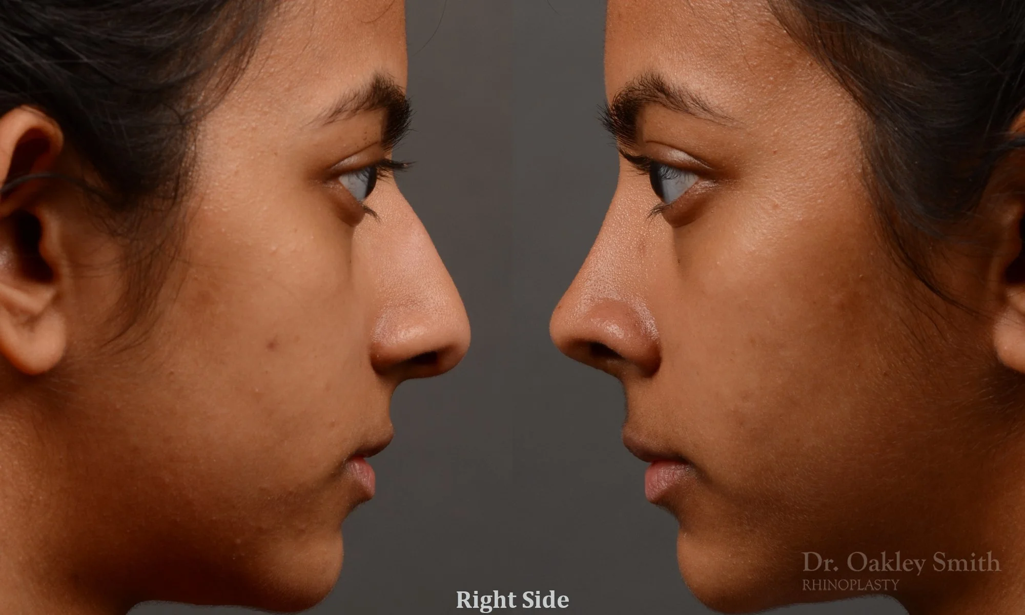 399: Female, Ethnic Rhinoplasty, Dorsal Hump, Tip Refinement