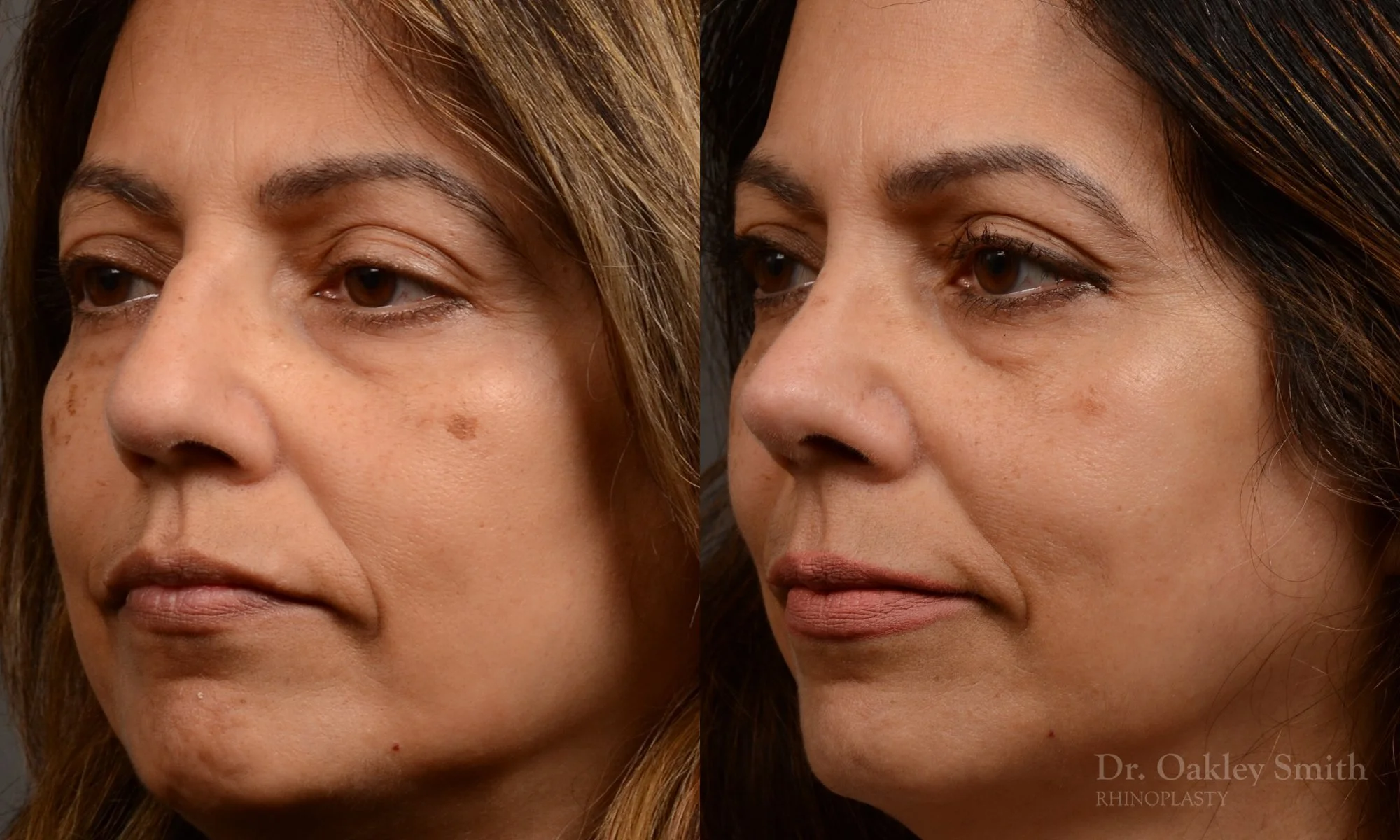 500D-rhinoplasty-dr-oakley-smith-toronto-top-surgeon-nose-job.jpg