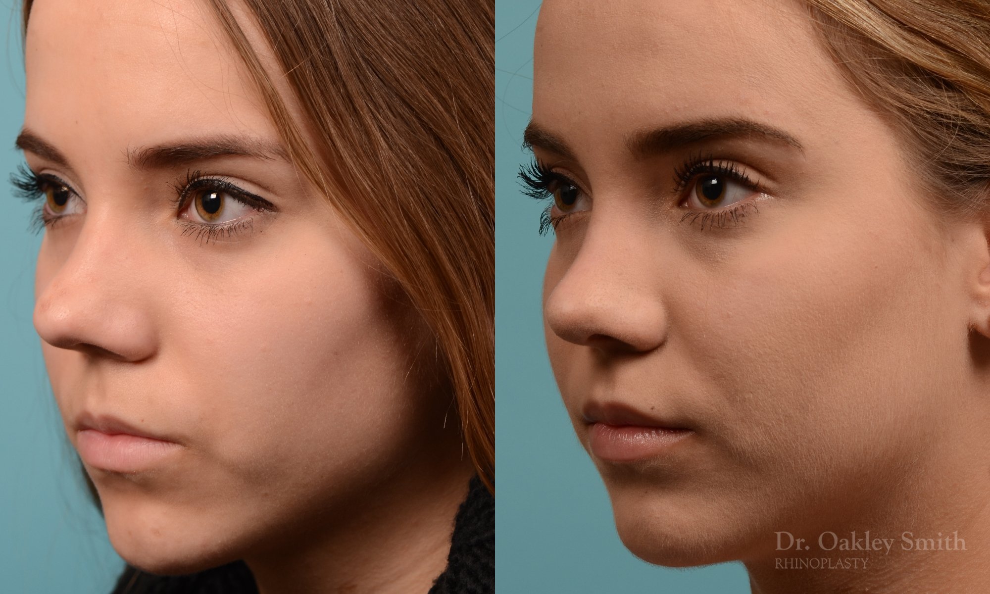 355D-rhinoplasty-dr-oakley-smith-toronto-nose-job.jpg