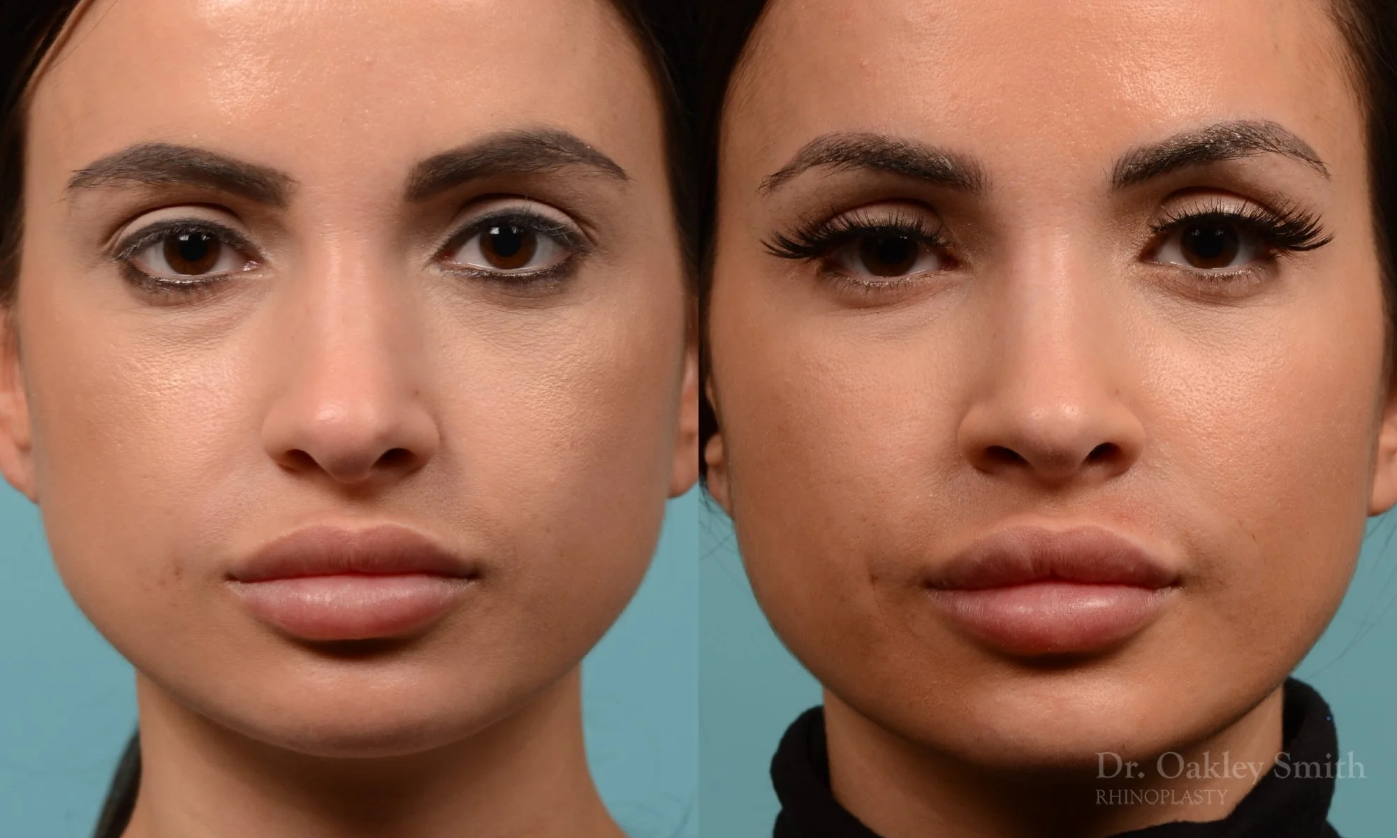 259A-rhinoplasty-dr-oakley-smith-toronto-nose-job.jpg