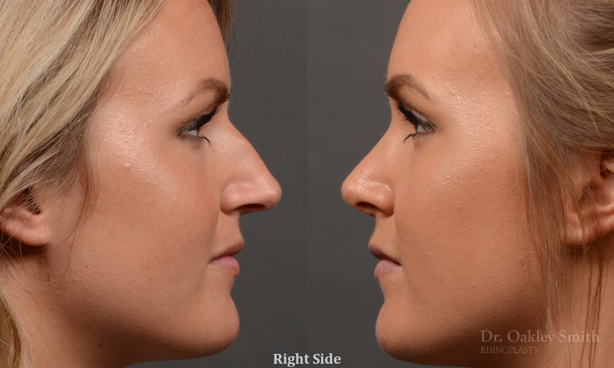 336: Female, Primary Rhinoplasty, Dorsal Bump, Tip Rotation