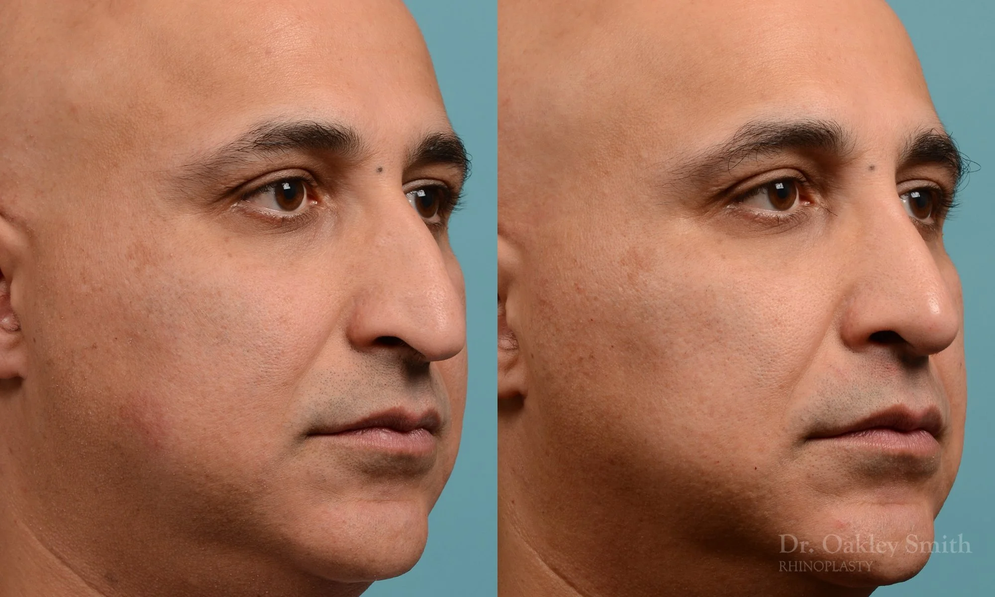 349.1B-rhinoplasty-dr-oakley-smith-toronto-nose-job.jpg