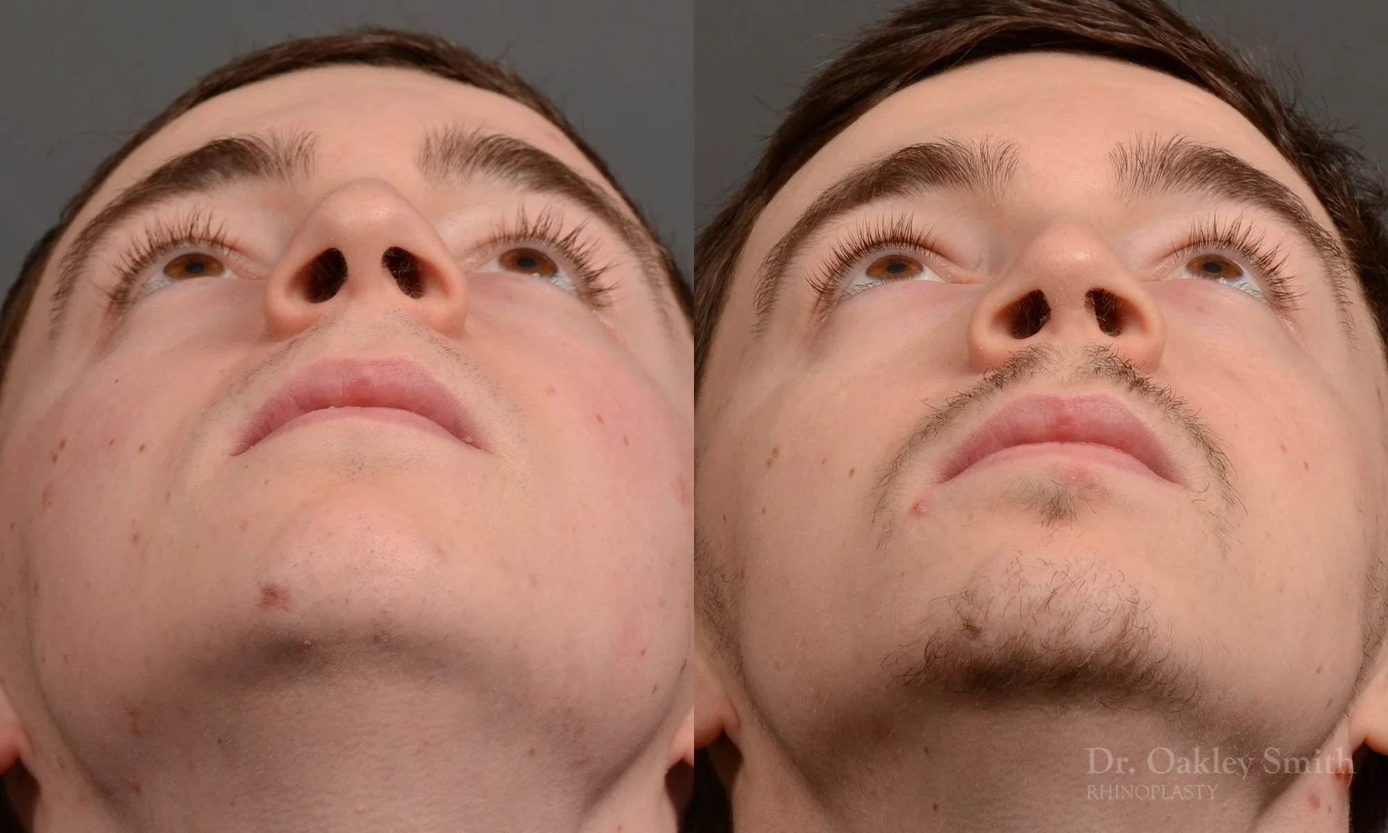 403F-male-rhinoplasty-dr-oakley-smith-toronto-nose-job.jpg