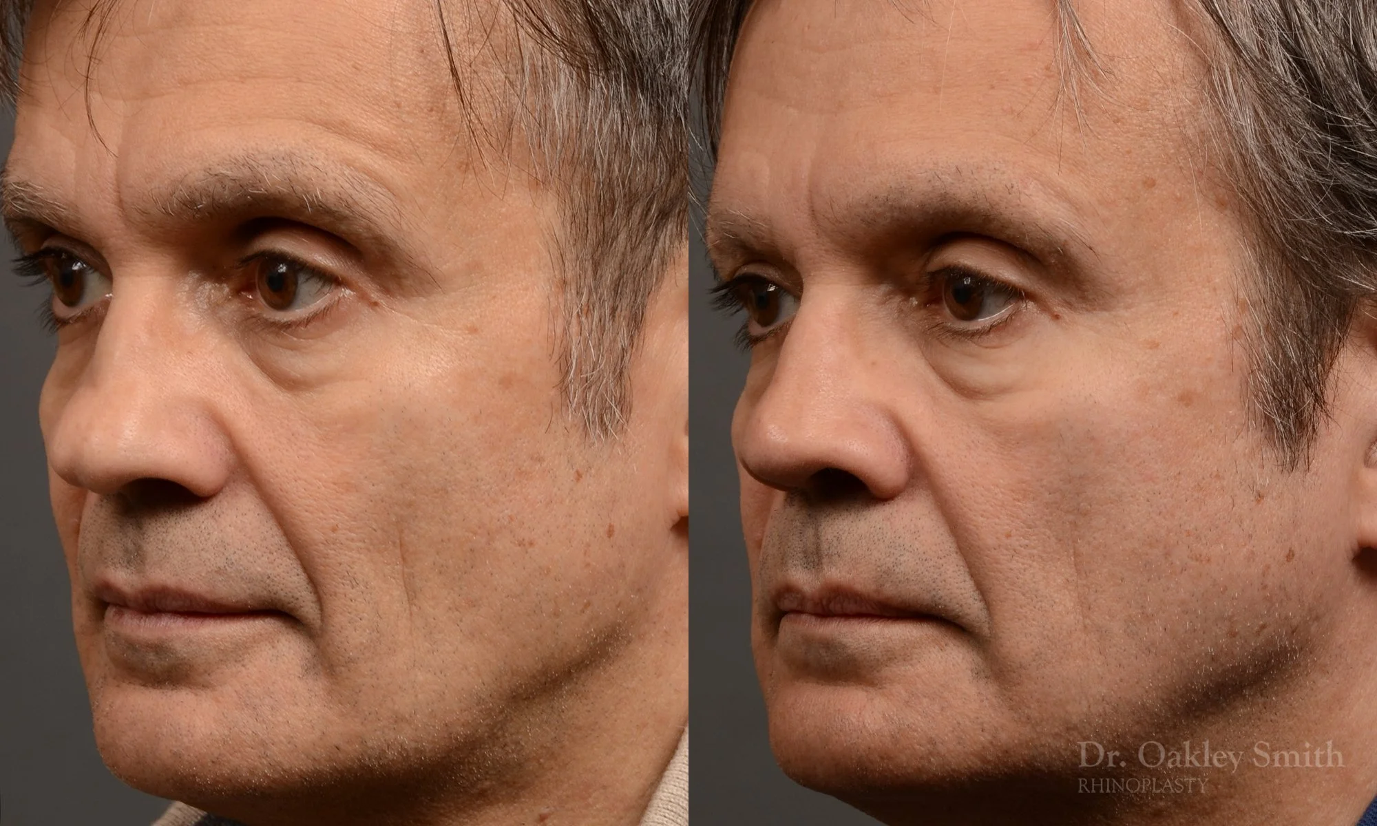 306.1D-rhinoplasty-dr-oakley-smith-toronto-nose-job.jpg