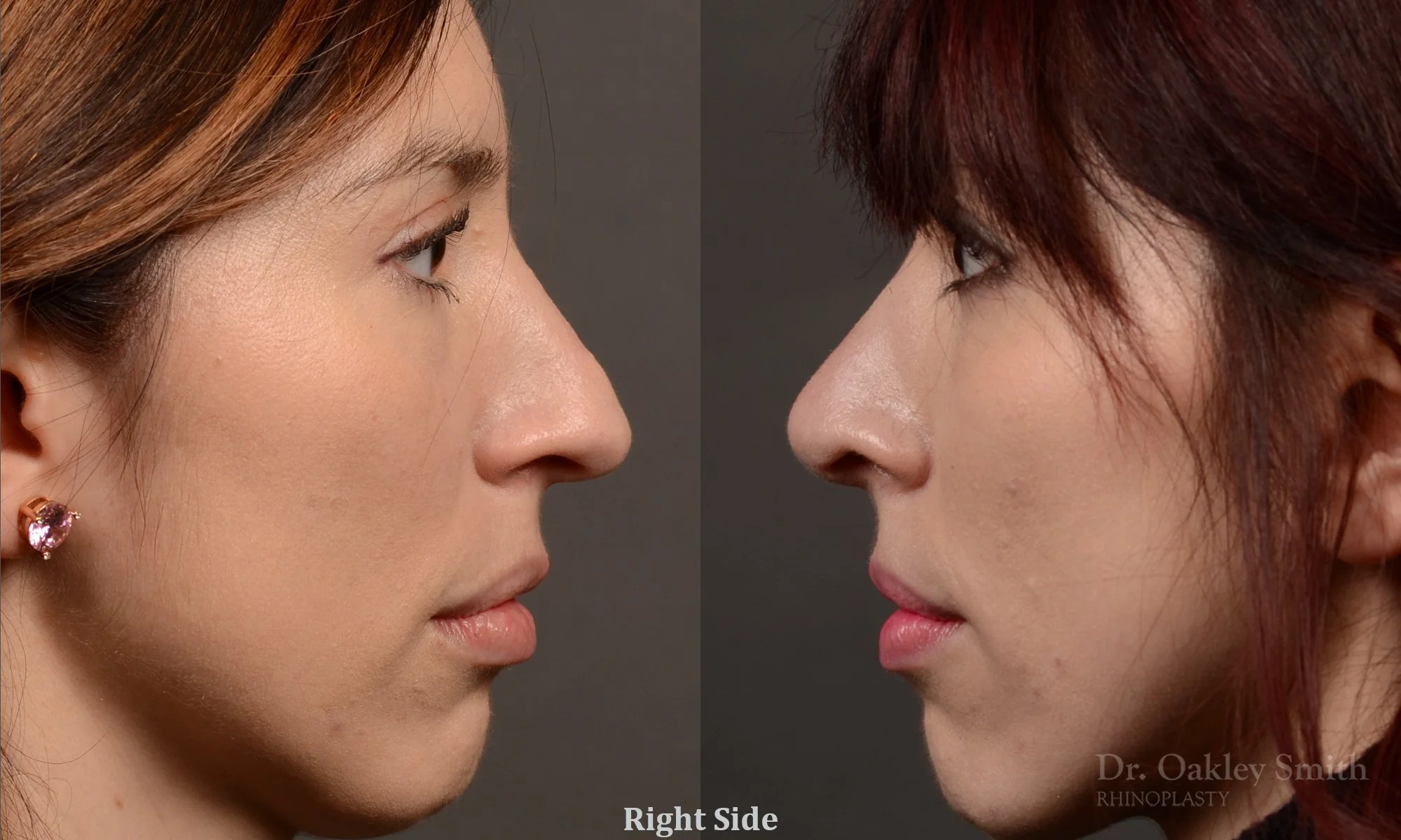 525C-rhinoplasty-dr-oakley-smith-toronto-top-surgeon-nose-job.jpg