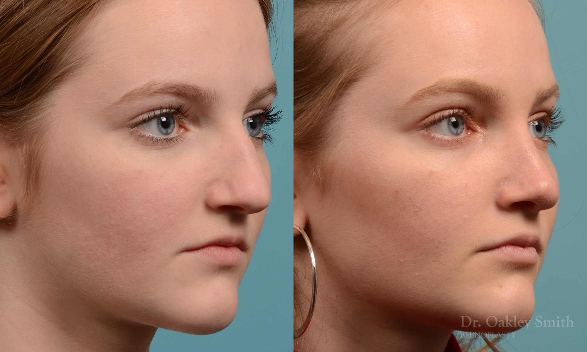 314B-rhinoplasty-dr-oakley-smith-toronto-nose-job.jpg