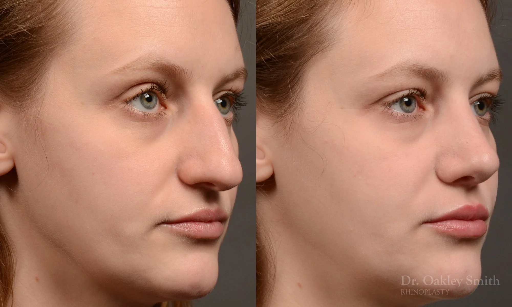 539B-rhinoplasty-dr-oakley-smith-toronto-nose-job.jpg