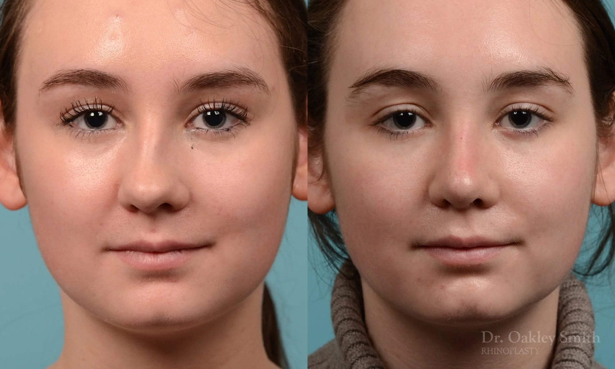 264: Female Rhinoplasty, Crooked, Tip Narrowing Refinement