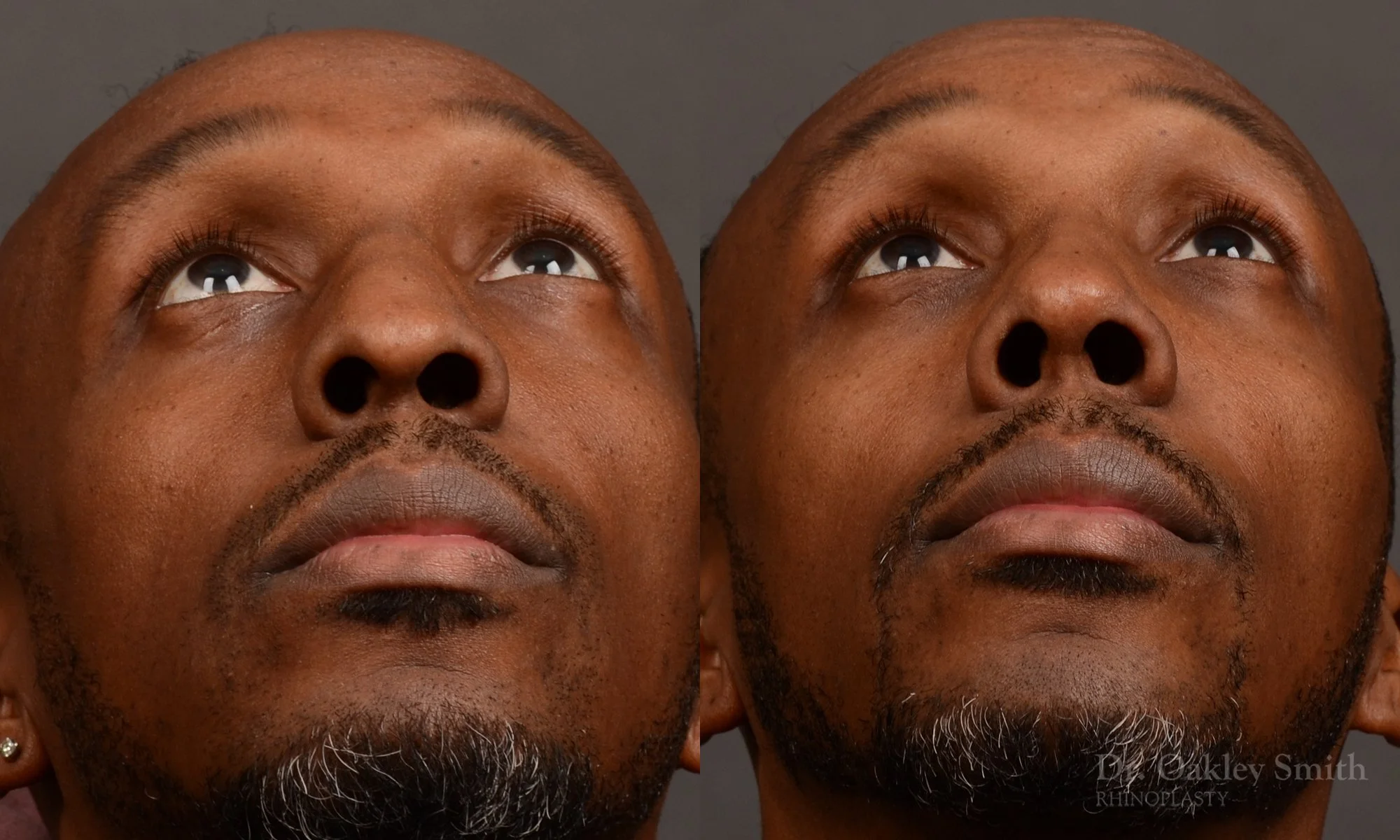 504F-malerhinoplasty-dr-oakley-smith-toronto-top-surgeon-nose-job.jpg