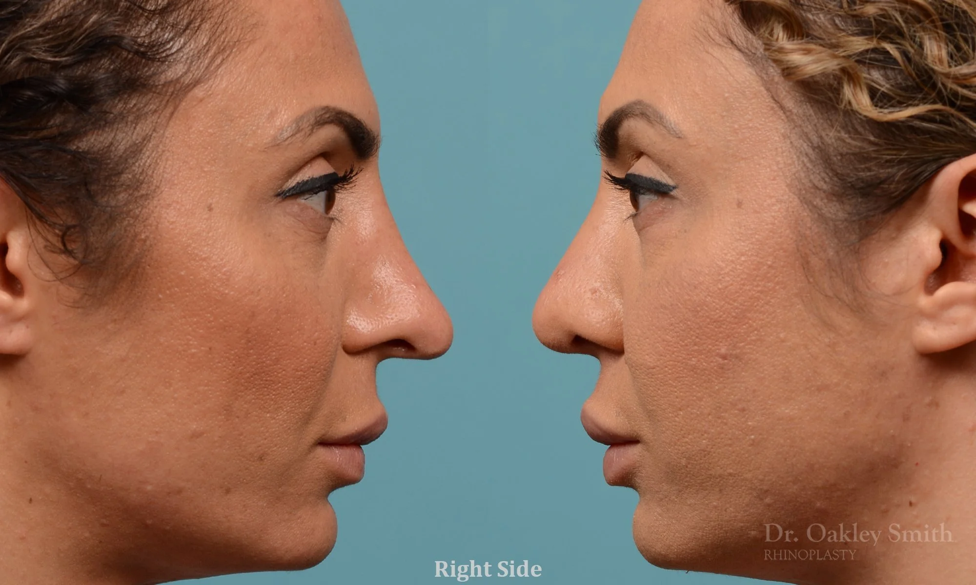 338: Female, Ethnic Rhinoplasty, Thick Skin, Tip Rotation and Deprojection