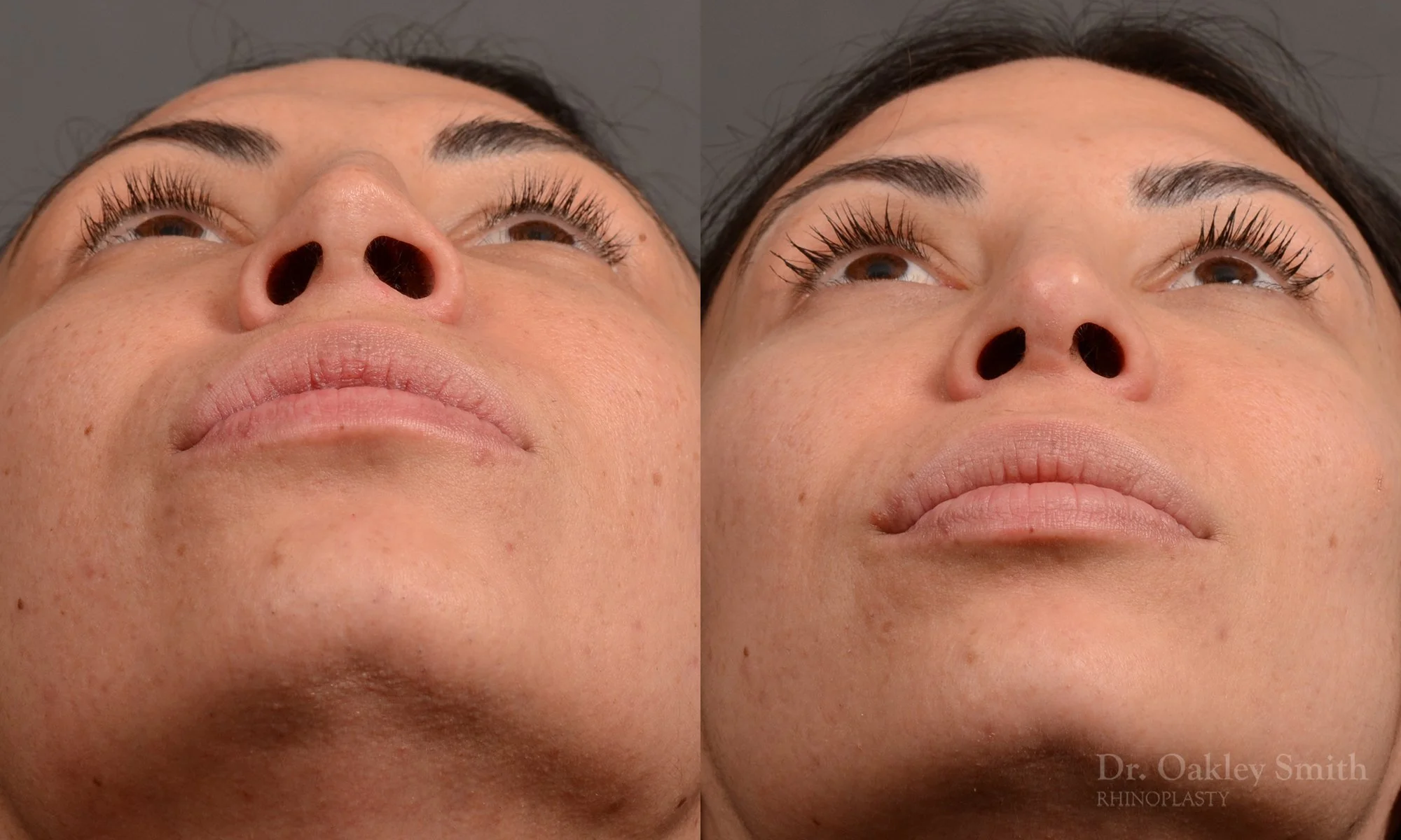 279.1F-rhinoplasty-dr-oakley-smith-toronto-nose-job.jpg