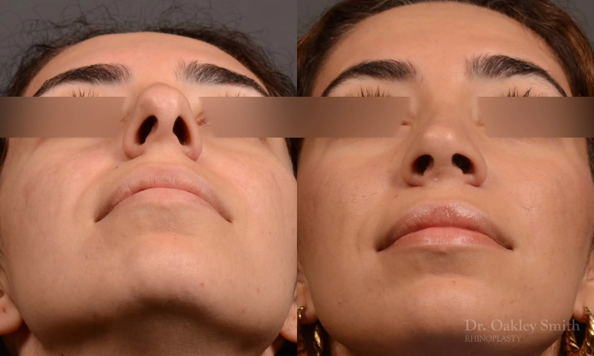 488F-rrhinoplasty-dr-oakley-smith-toronto-top-surgeon-nose-job.jpg