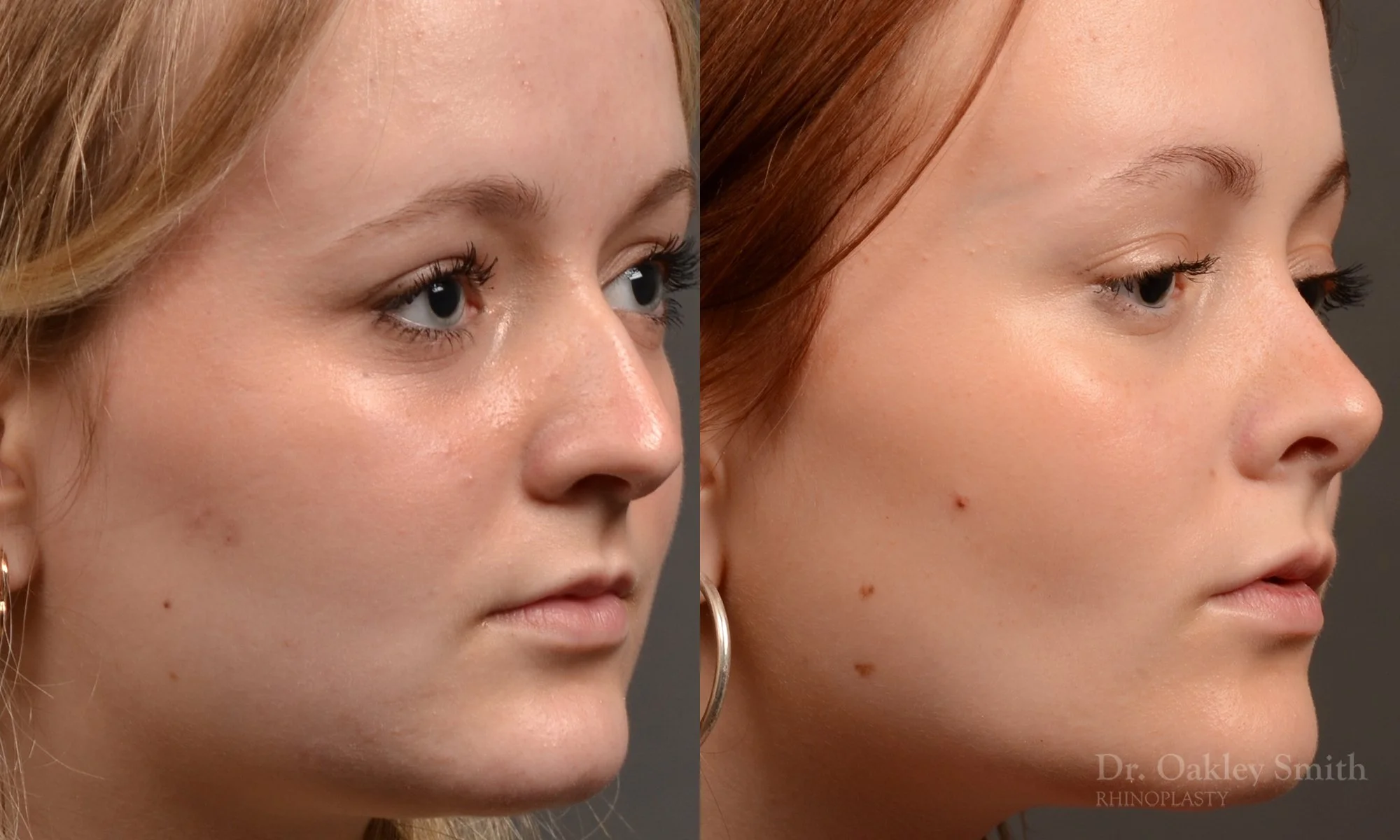 475B-rhinoplasty-dr-oakley-smith-toronto-top-surgeon-nose-job.jpg