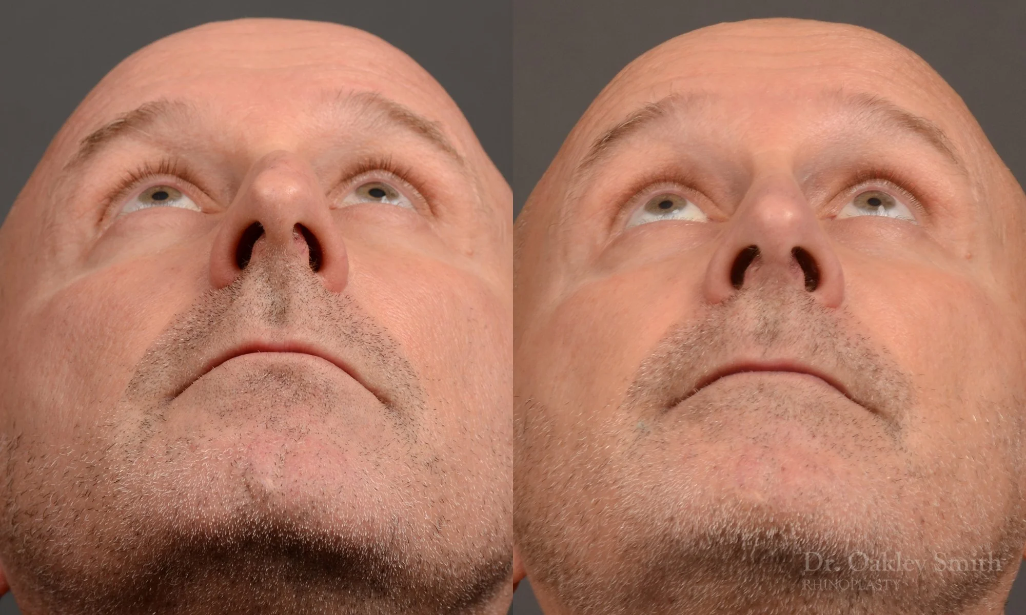 493F-male-rhinoplasty-dr-oakley-smith-toronto-top-surgeon-nose-job.jpg