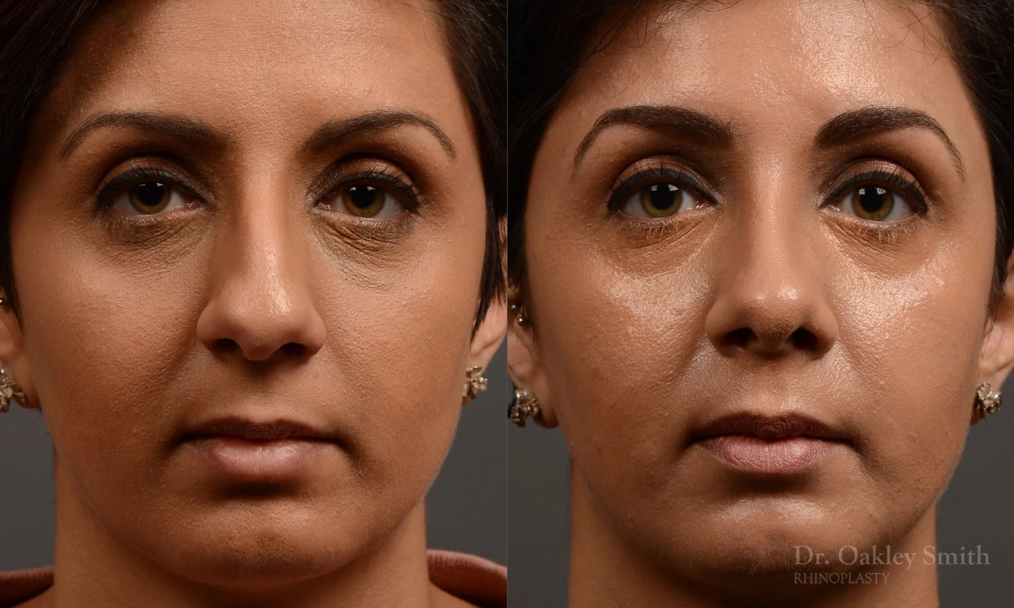 376.1A-rhinoplasty-dr-oakley-smith-toronto-nose-job.jpg