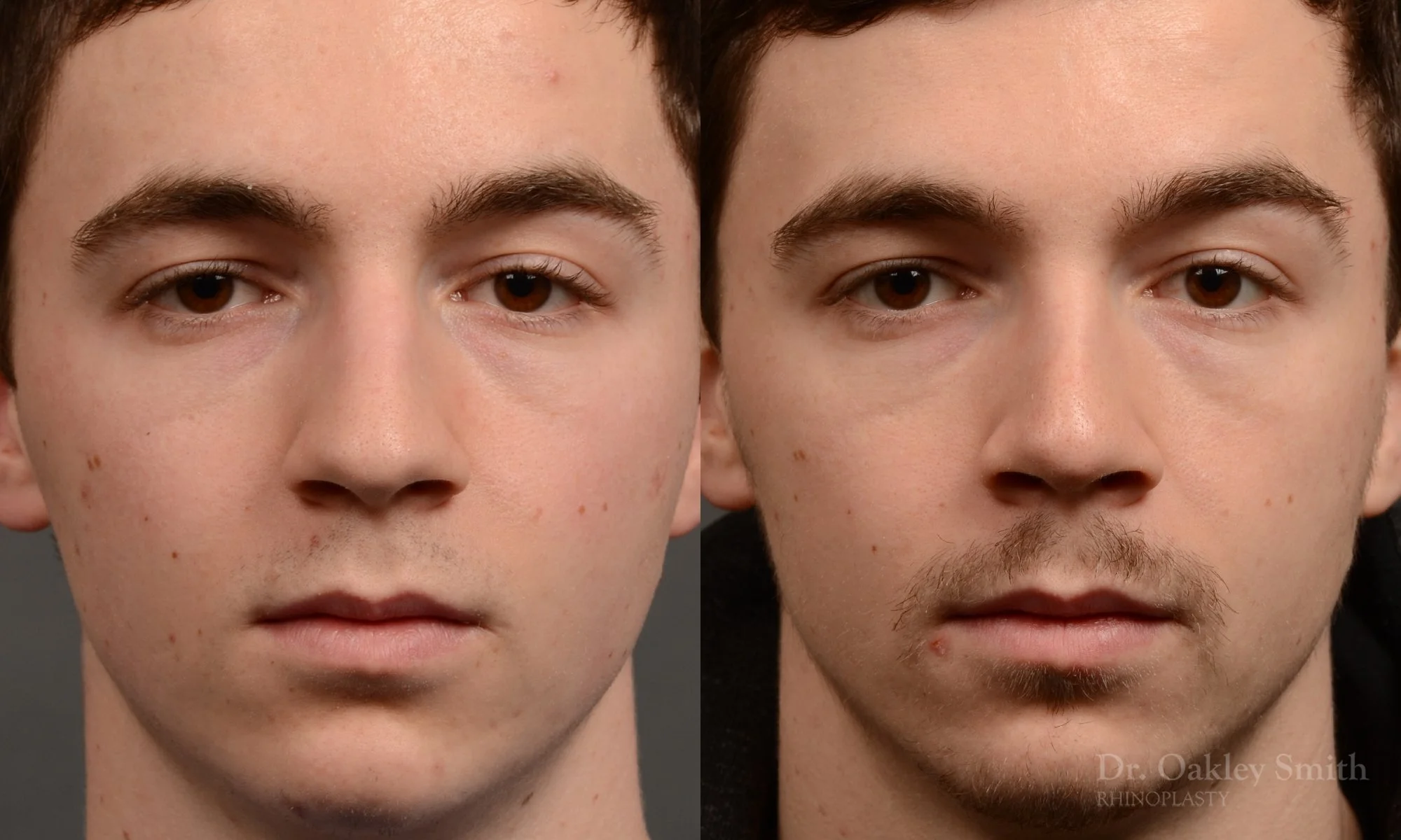 403A-male-rhinoplasty-dr-oakley-smith-toronto-nose-job.jpg