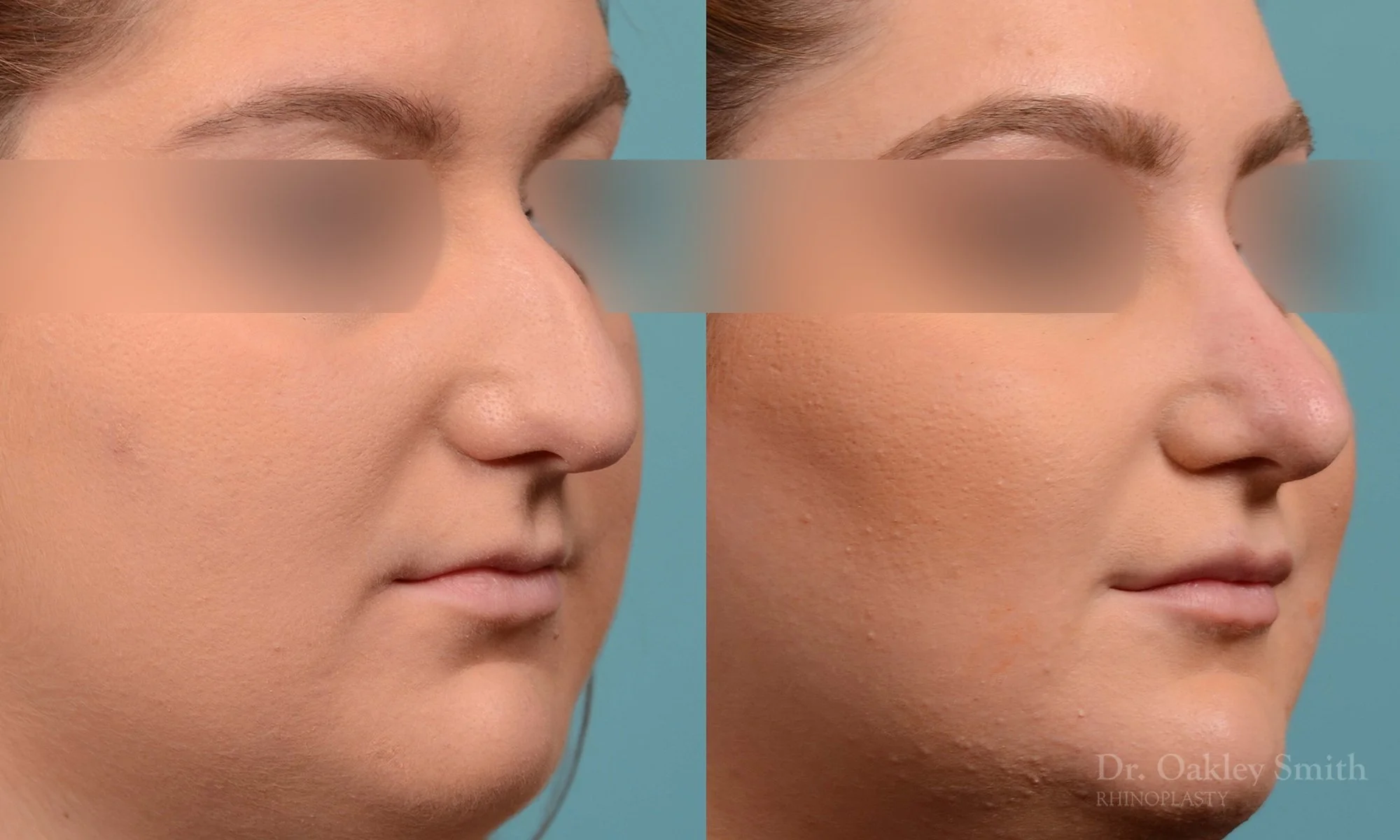 235B-watermark-curved-nose-nose-job-dr-oakley-smith-toronto-rhinoplasty-bump-on-bridge.jpg
