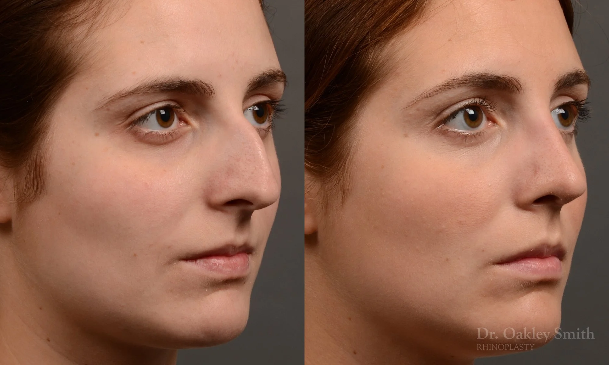 305B-rhinoplasty-dr-oakley-smith-toronto-nose-job.jpg