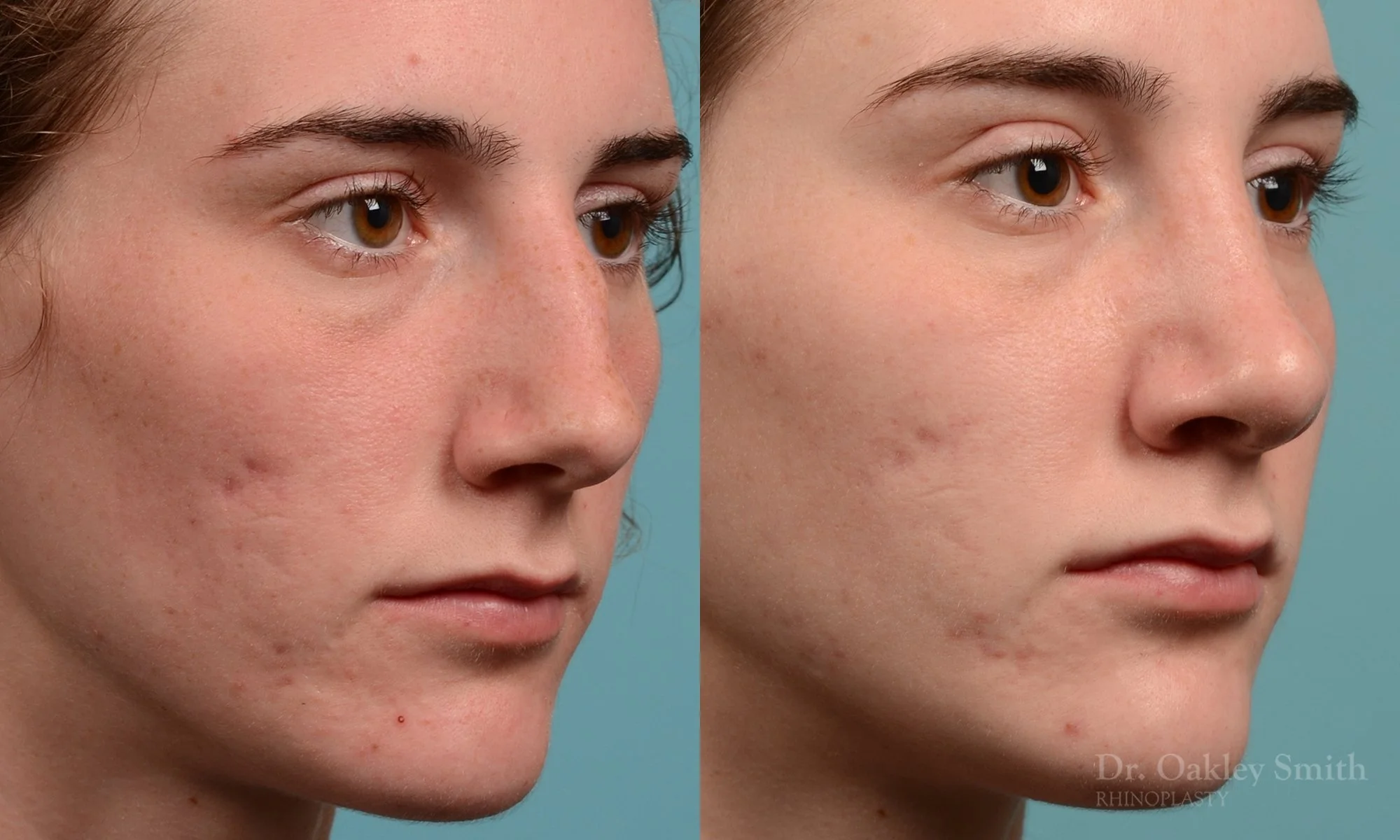 248B-rhinoplasty-dr-oakley-smith-toronto-nose-job.jpg
