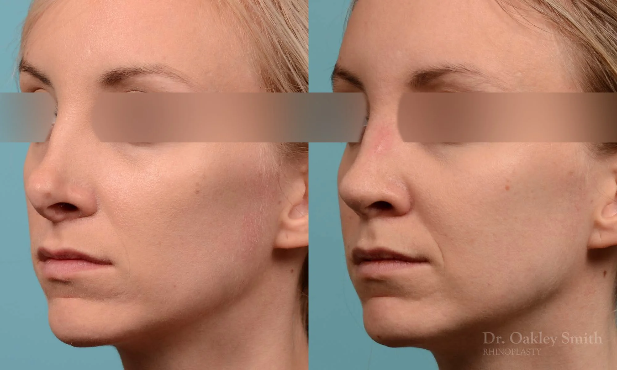 280D-rhinoplasty-dr-oakley-smith-toronto-nose-job.jpg