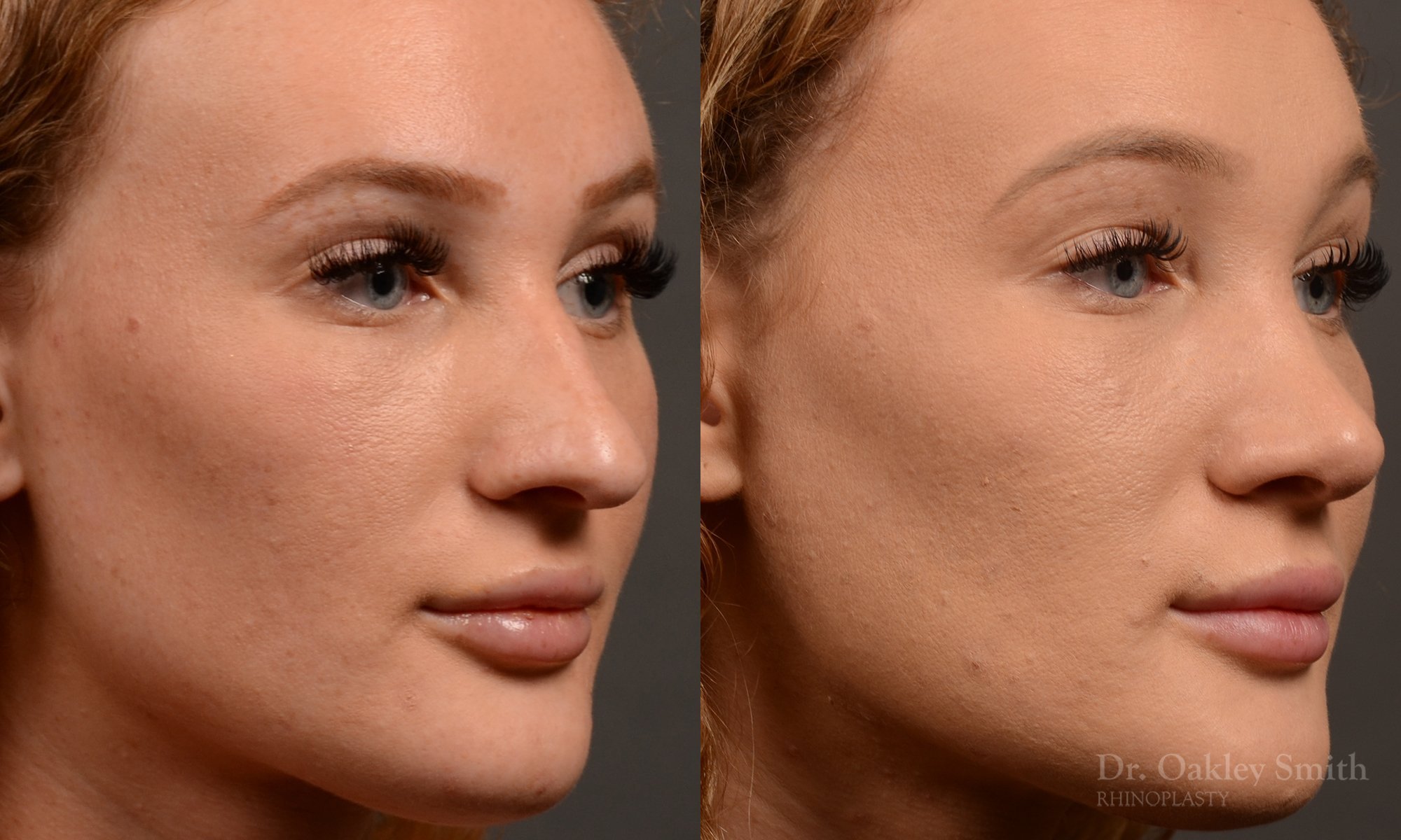 491B-rhinoplasty-dr-oakley-smith-toronto-top-surgeon-nose-job.jpg