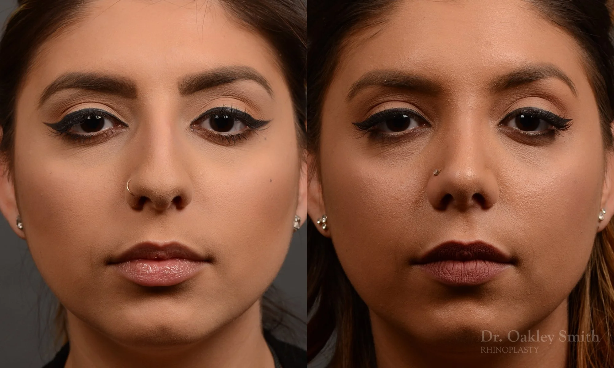 350A-rhinoplasty-dr-oakley-smith-toronto-nose-job - Copy.jpg
