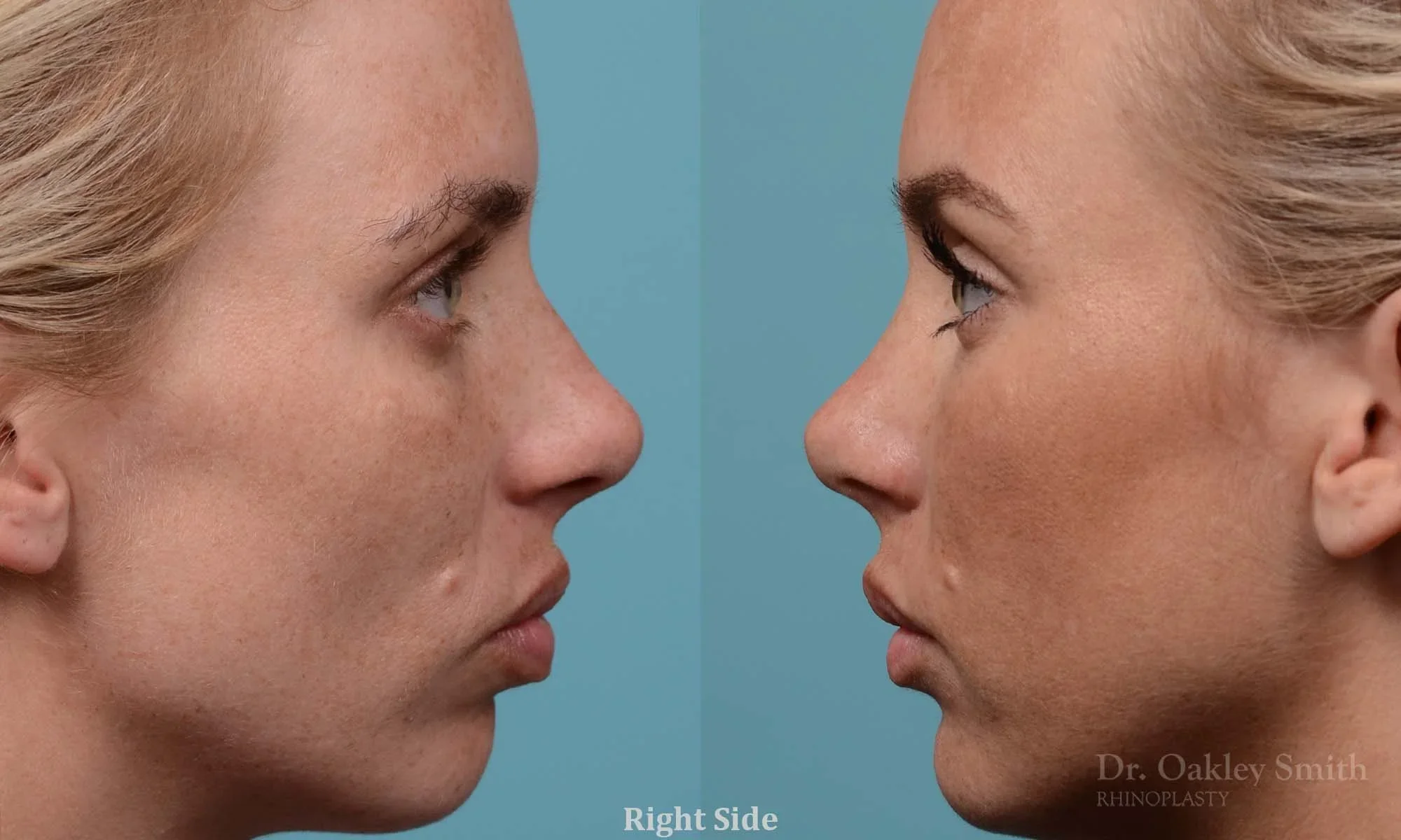 284: Female,  Rhinoplasty, Thin Skin, Tip and Small Bump Refinement