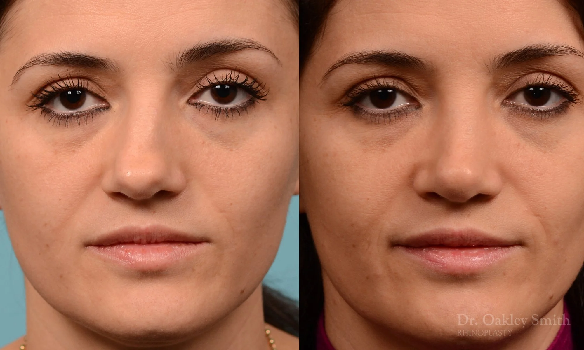 234A-nose-job-nose-reduction-rhinoplasty-pointy-nose-curved-nose-dr-oakley-smith-toronto.jpg