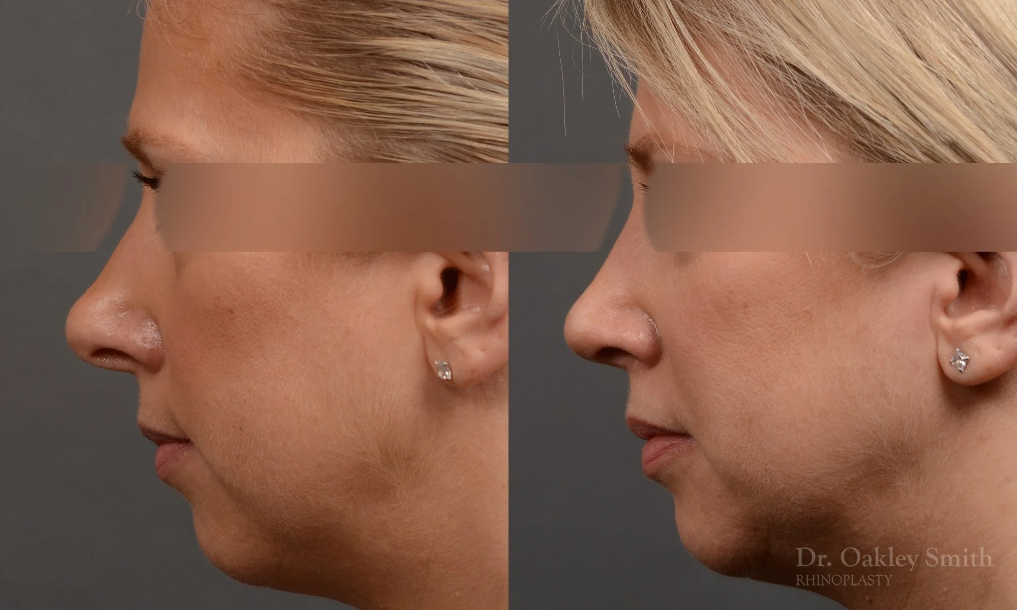 344E-rhinoplasty-dr-oakley-smith-toronto-nose-job-1.jpg