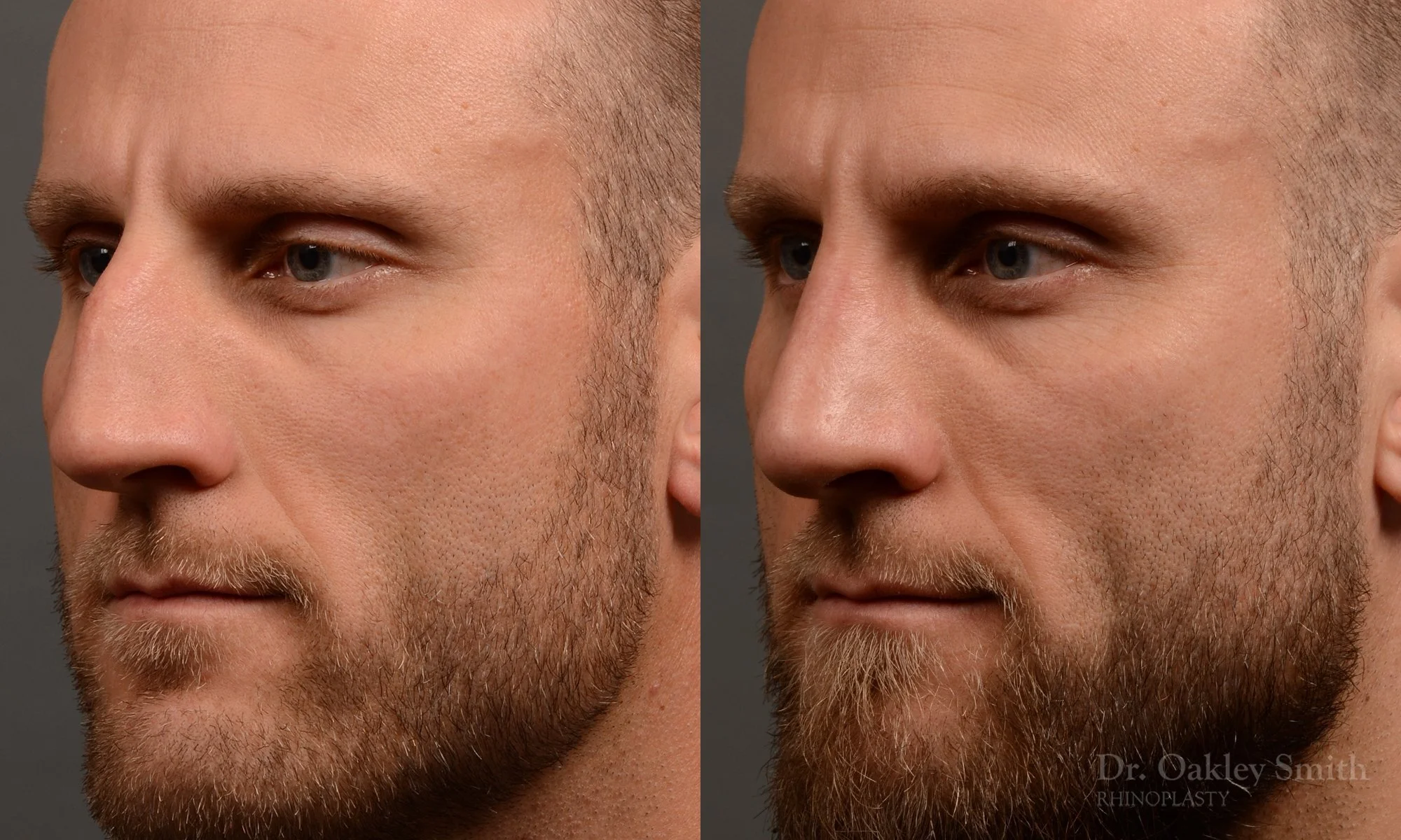 367.1D-rhinoplasty-dr-oakley-smith-toronto-male-nose-job.jpg