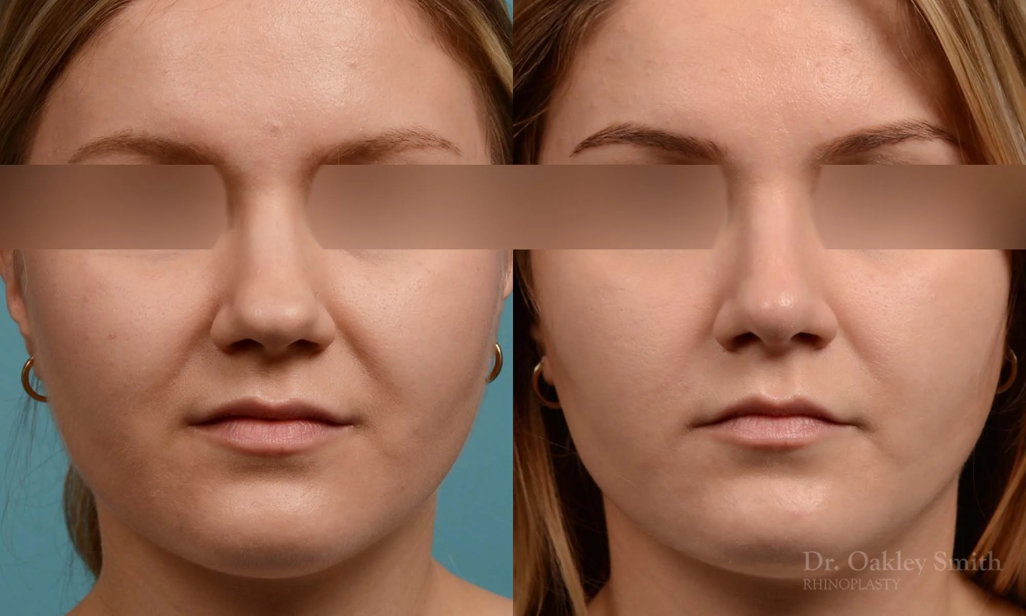 292: Female Rhinoplasty, Dorsal Hump, Bulbous Tip