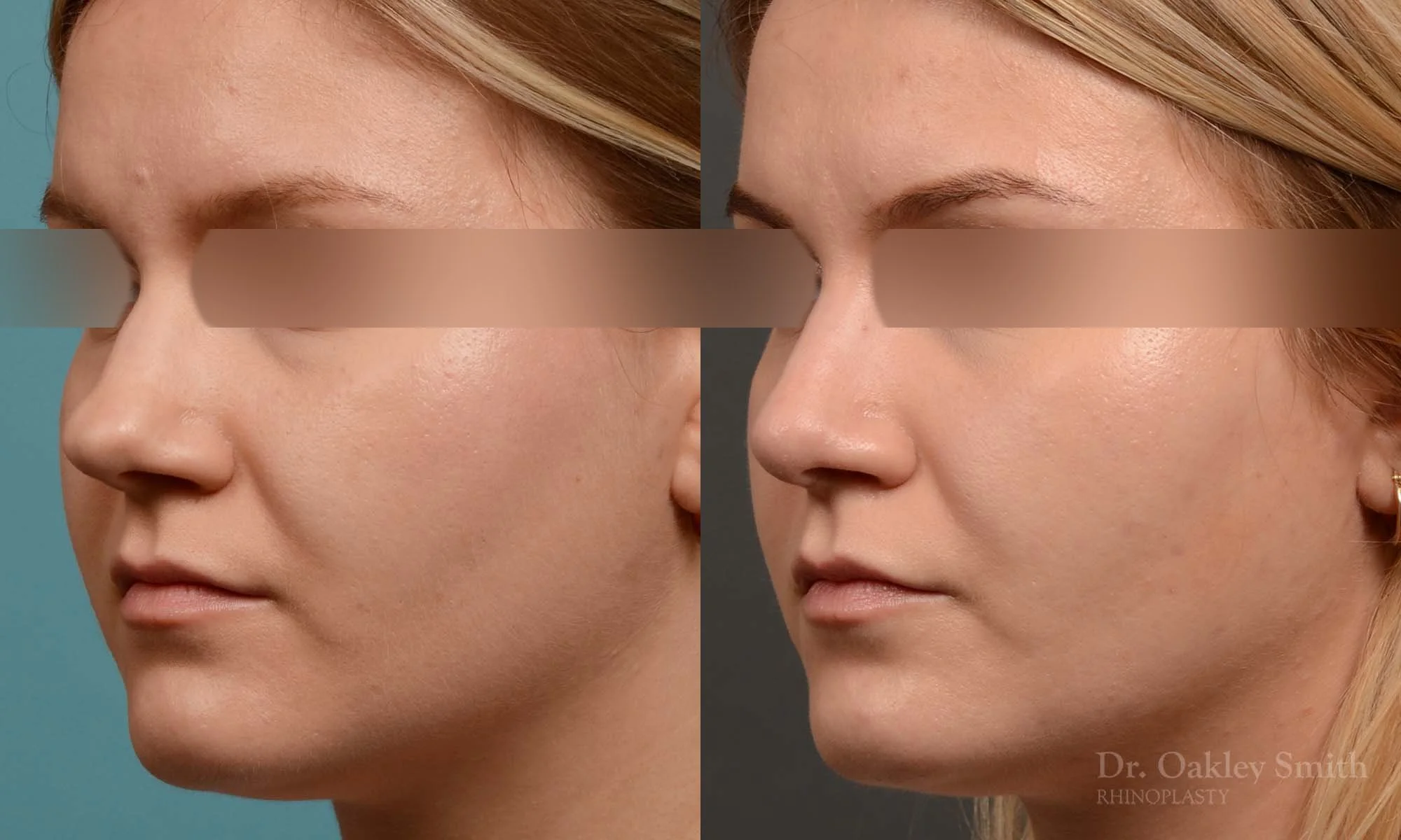 292D-rhinoplasty-dr-oakley-smith-toronto-nose-job.jpg
