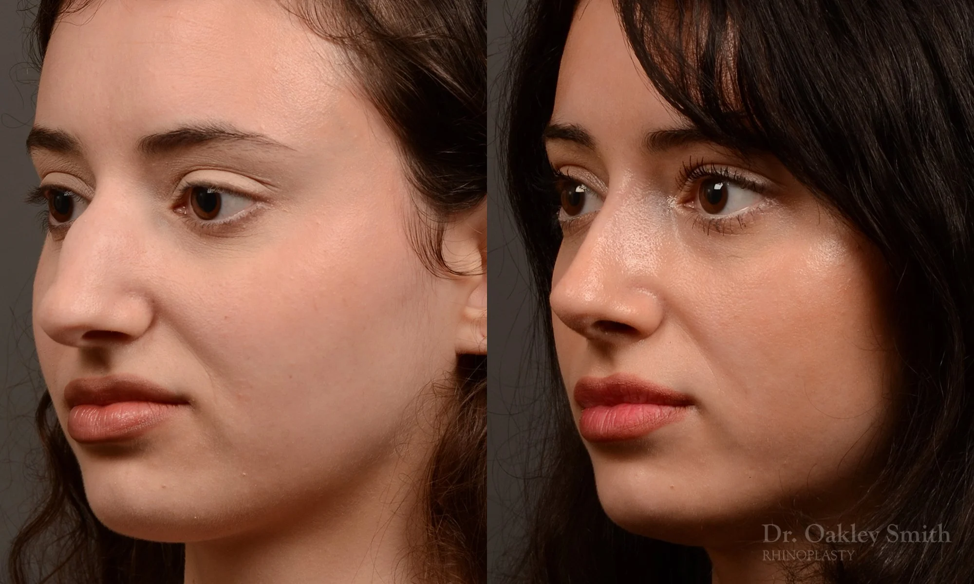 547D-rhinoplasty-dr.-oakley-smith-top-rhino-surgeon-toronto.jpg