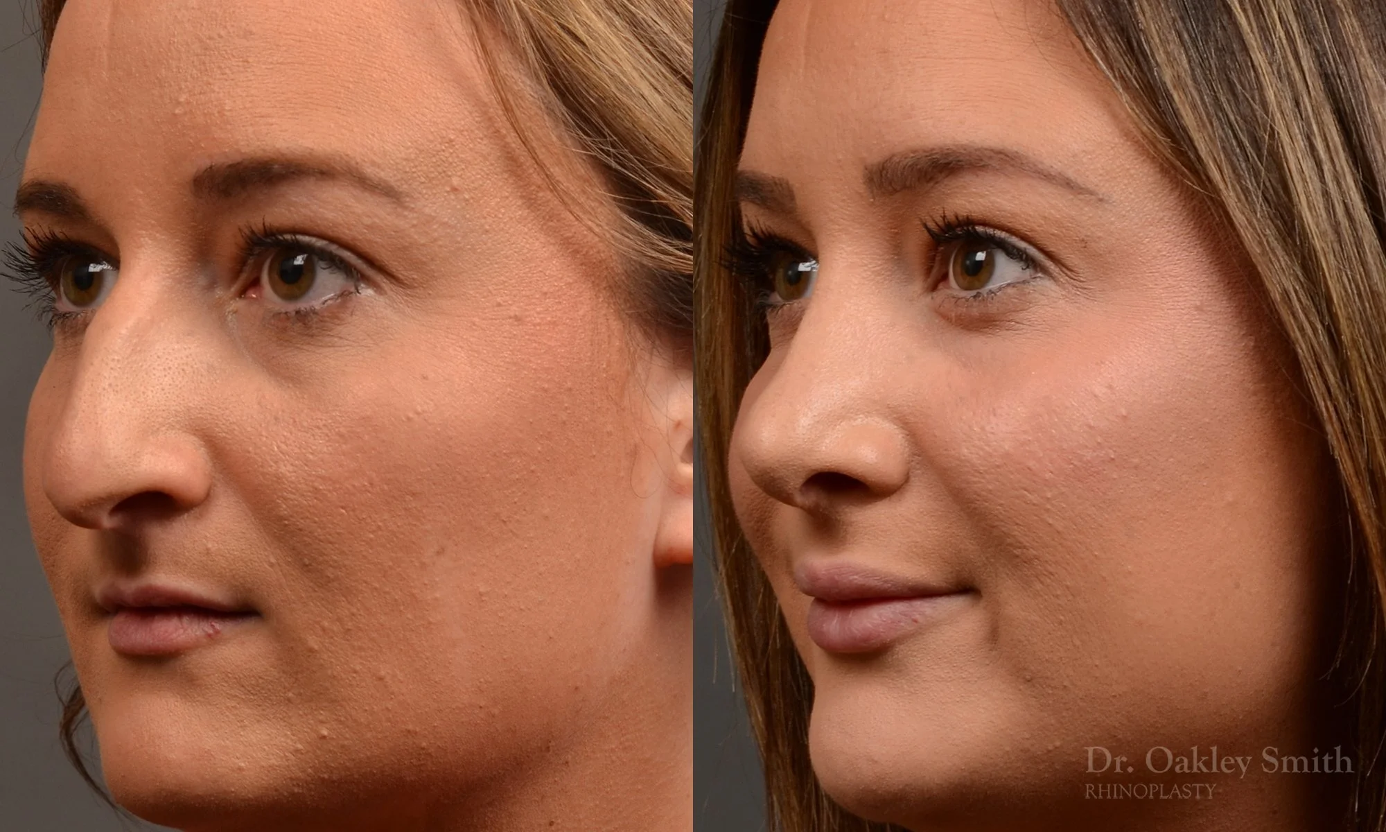 478D-rhinoplasty-dr-oakley-smith-toronto-top-surgeon-nose-job.jpg