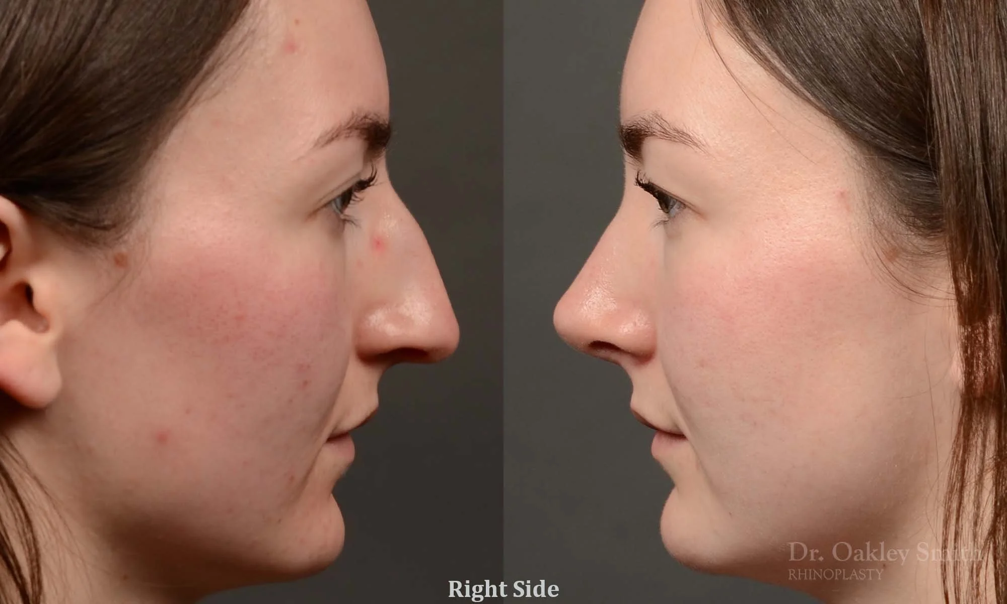 Case 501 Dr. Oakley Smith, preservation rhinoplasty, 12 months after surgery, right profile view