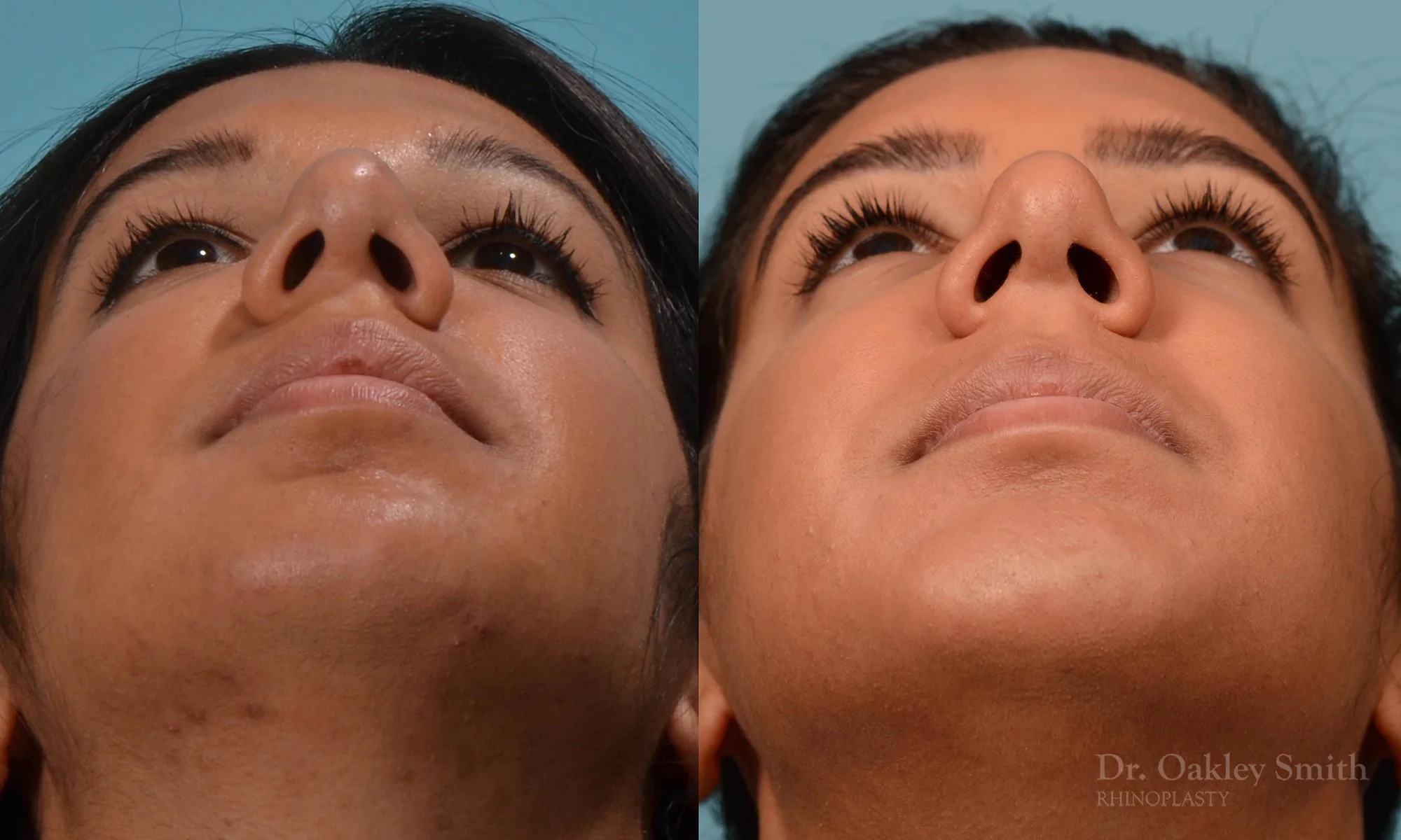 237F-rhinoplasty-dr-oakley-smith-1-1.jpg