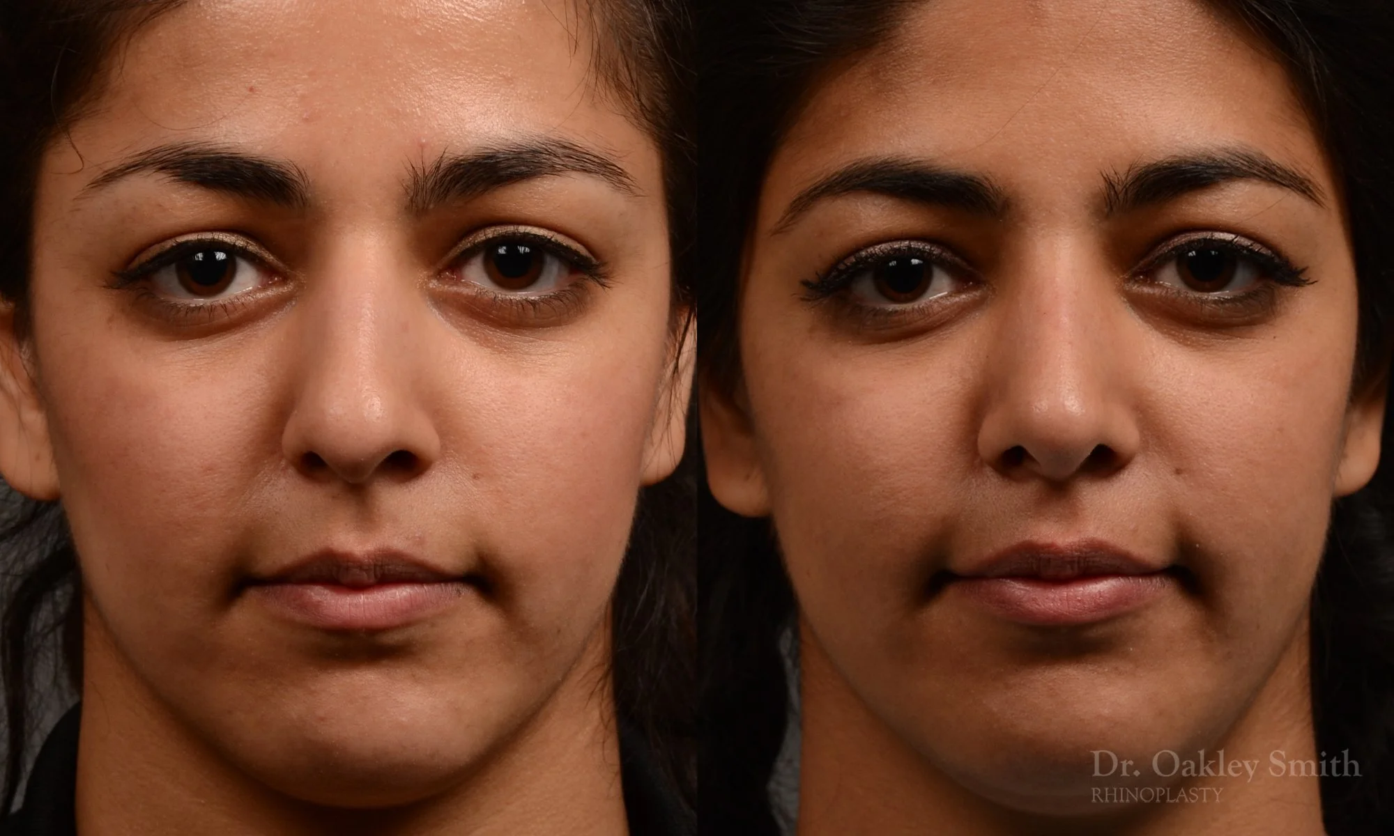 296.5A-rhinoplastydr-oakley-smith-toronto-nose-job.jpg