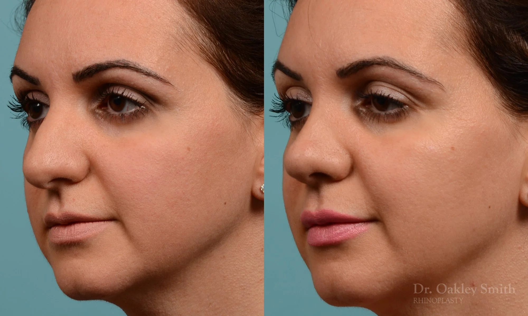 311D-rhinoplasty-dr-oakley-smith-toronto-nose-job.jpg