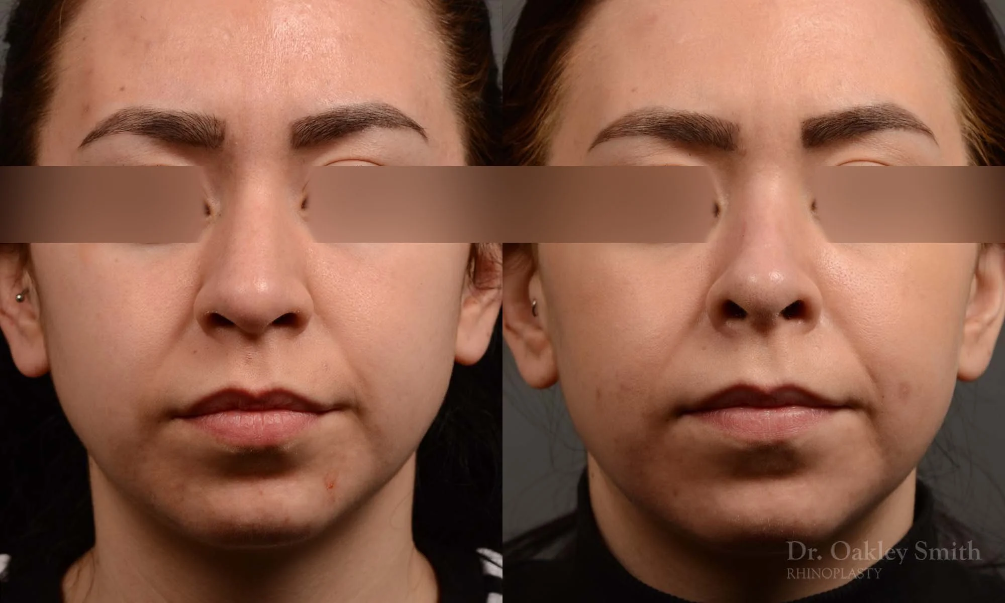 342A-rhinoplasty-dr-oakley-smith-toronto-nose-job.jpg