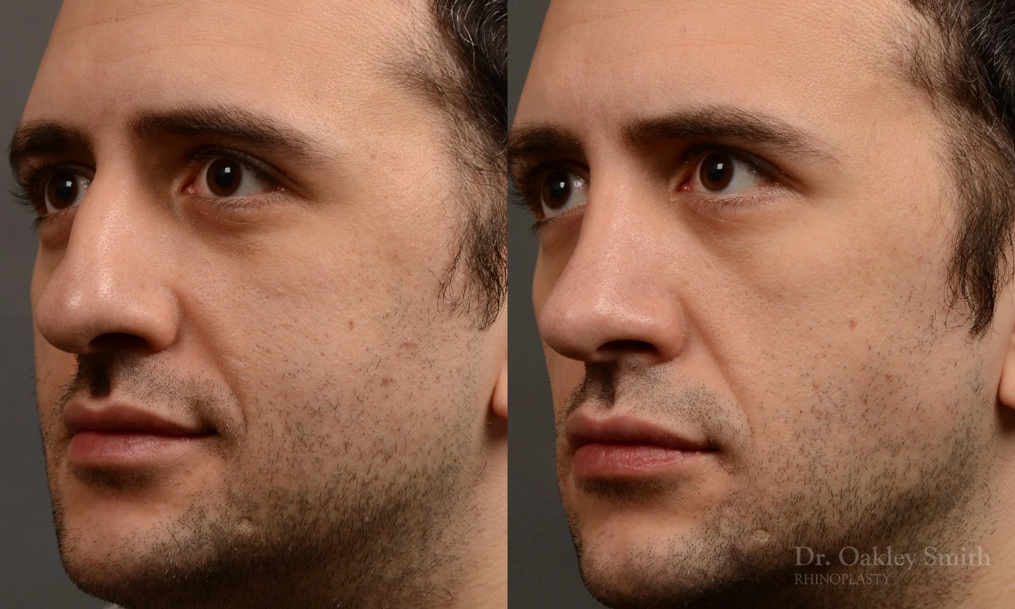 428D-male-rhinoplasty-dr-oakley-smith-toronto-top-surgeon-nose-job.jpg