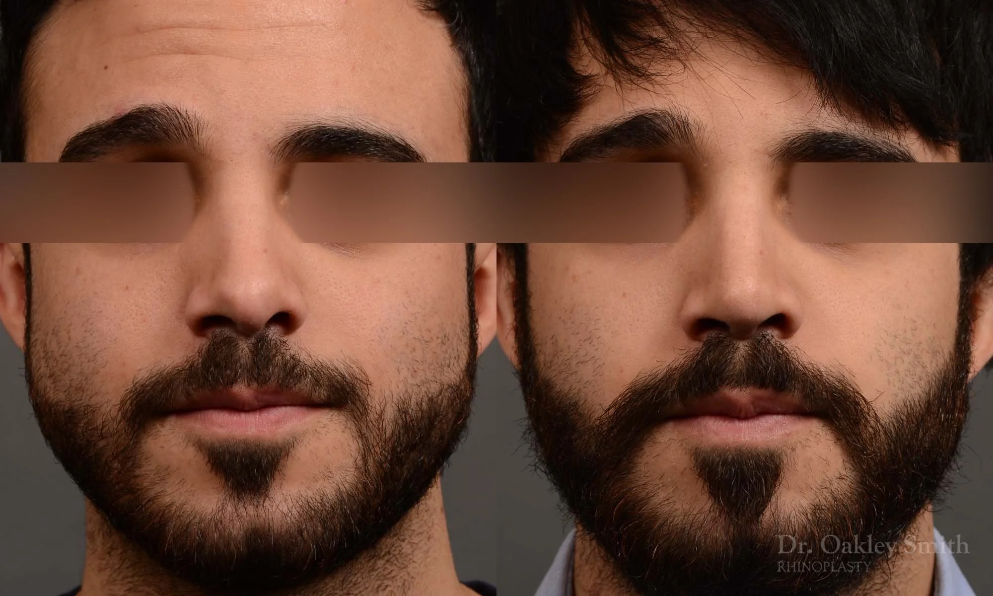 327.1A-rhinoplasty-dr-oakley-smith-toronto-nose-job.jpg