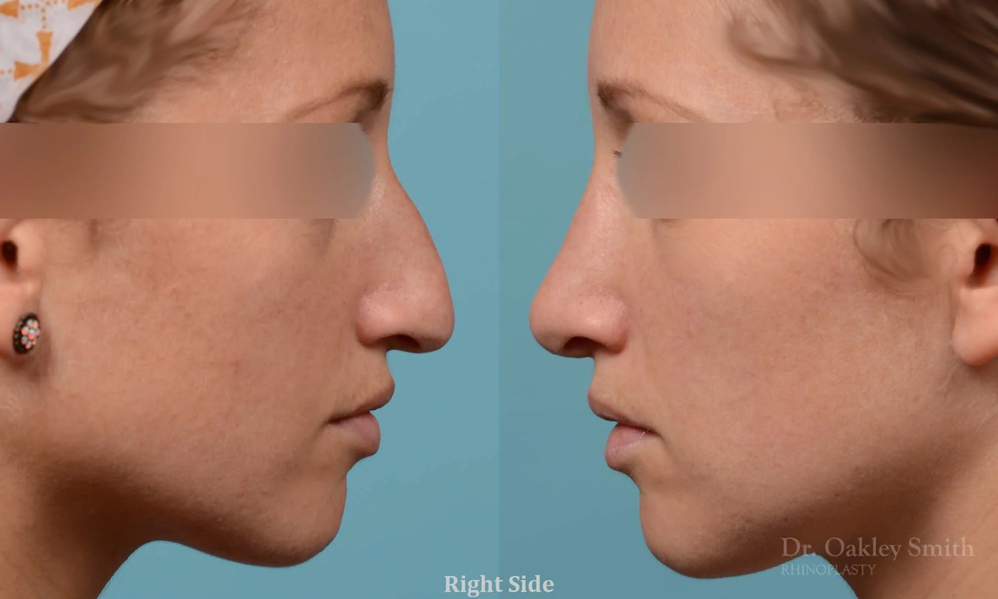 255: Female, Primary Rhinoplasty, Dorsal Bump, Tip Rotation