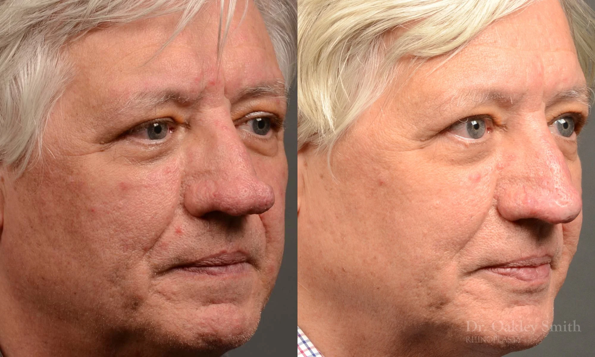 532.1B-Rhinophyma-nose-job-growth-toronto-nose-surgeon-dr-oakley-smith.jpg