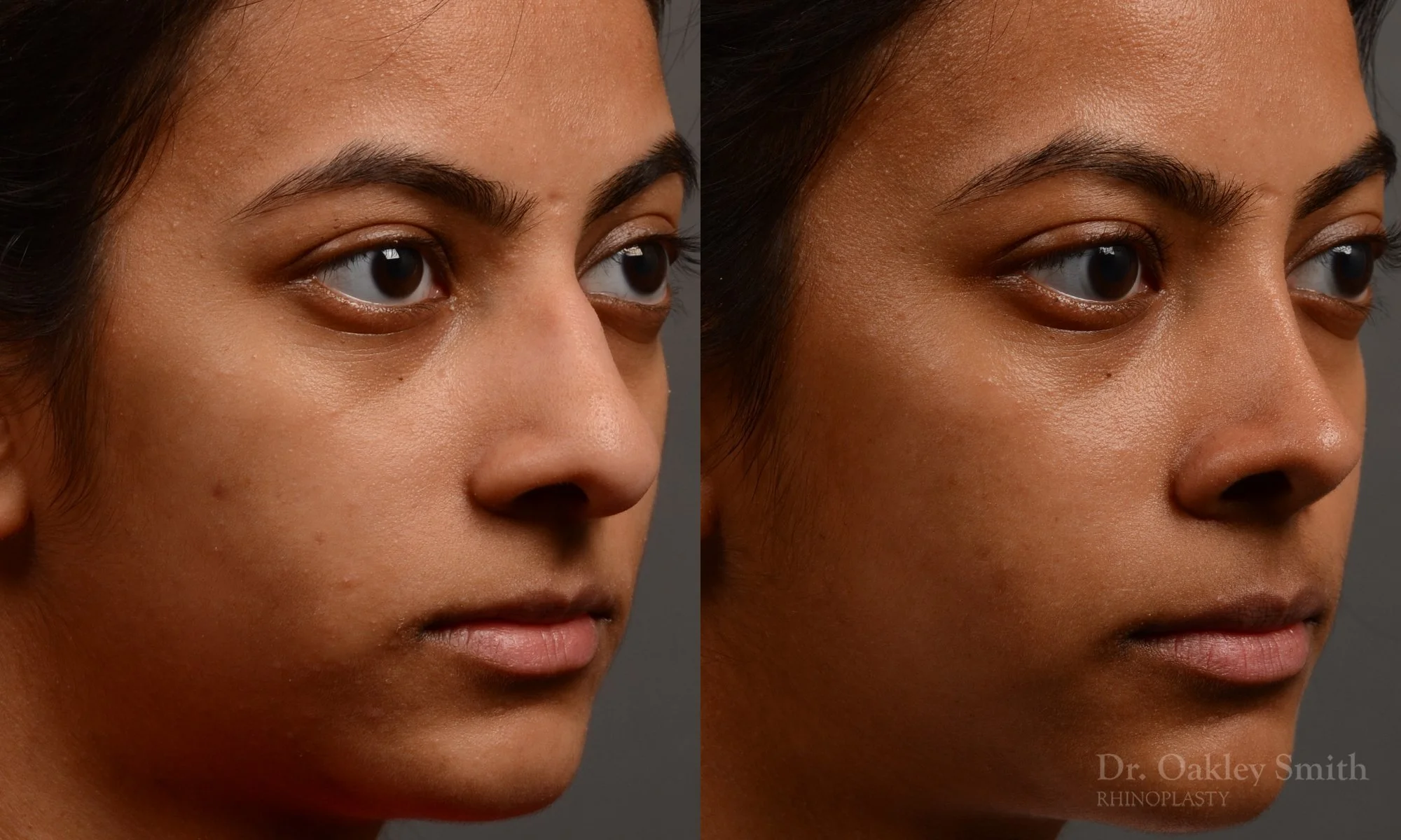 399B-expert-rhinoplasty-dr-oakley-smith-toronto-nose-job.jpg