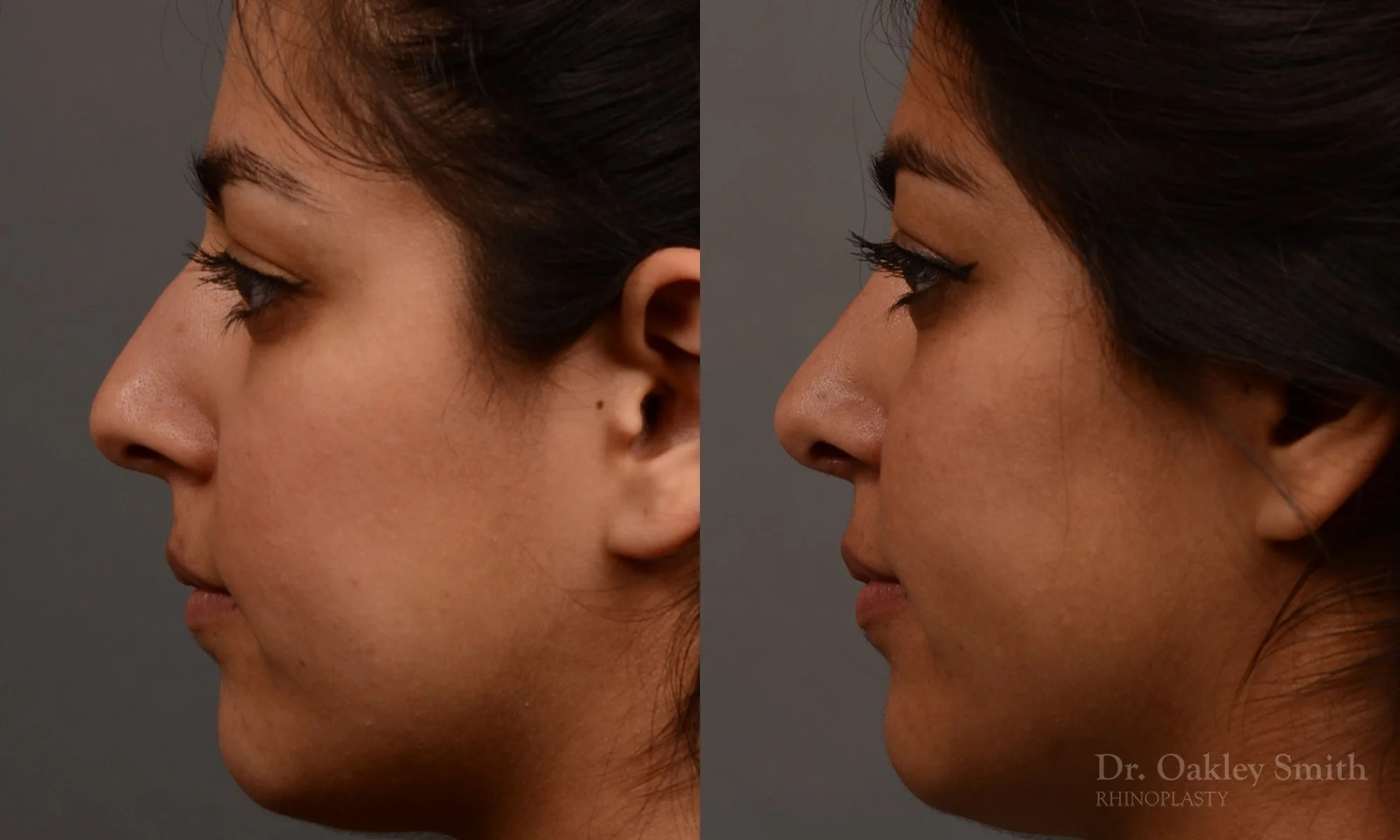 296.5E-rhinoplastydr-oakley-smith-toronto-nose-job.jpg