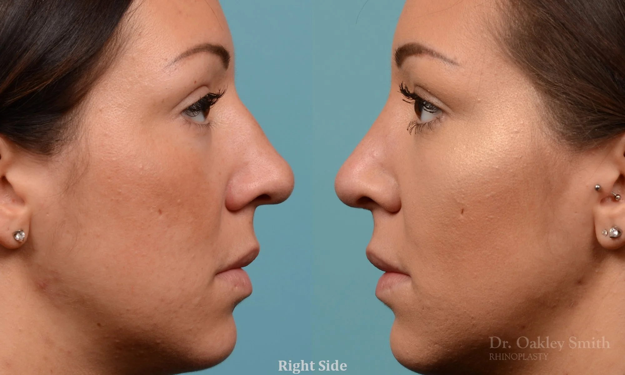 261: Female Rhinoplasty, Wide Dorsal Hump, Tip Narrowing Refinement