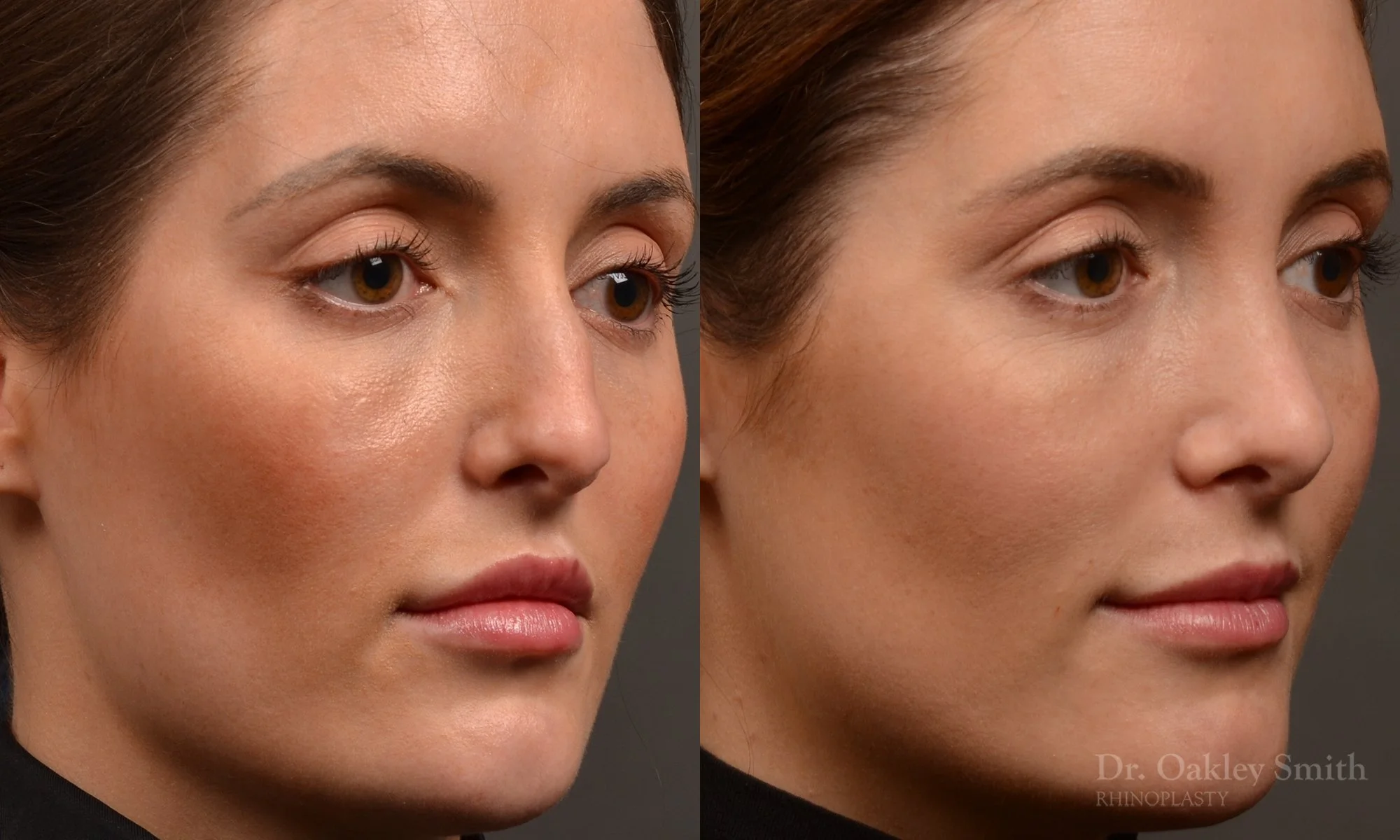 490B-rhinoplasty-dr-oakley-smith-toronto-top-surgeon-nose-job.jpg