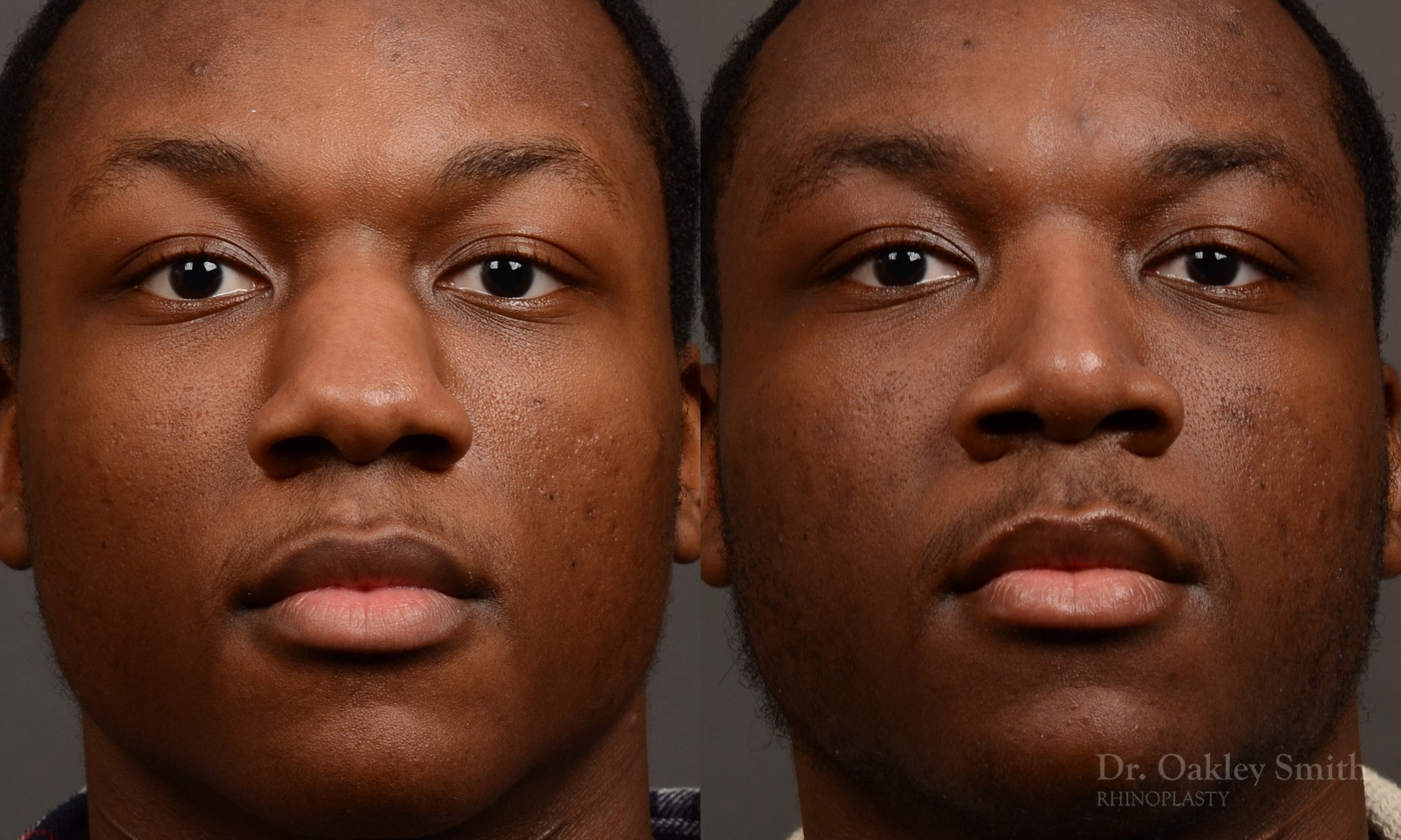 515A-male-rhinoplasty-dr-oakley-smith-toronto-top-surgeon-nose-job (1).jpg