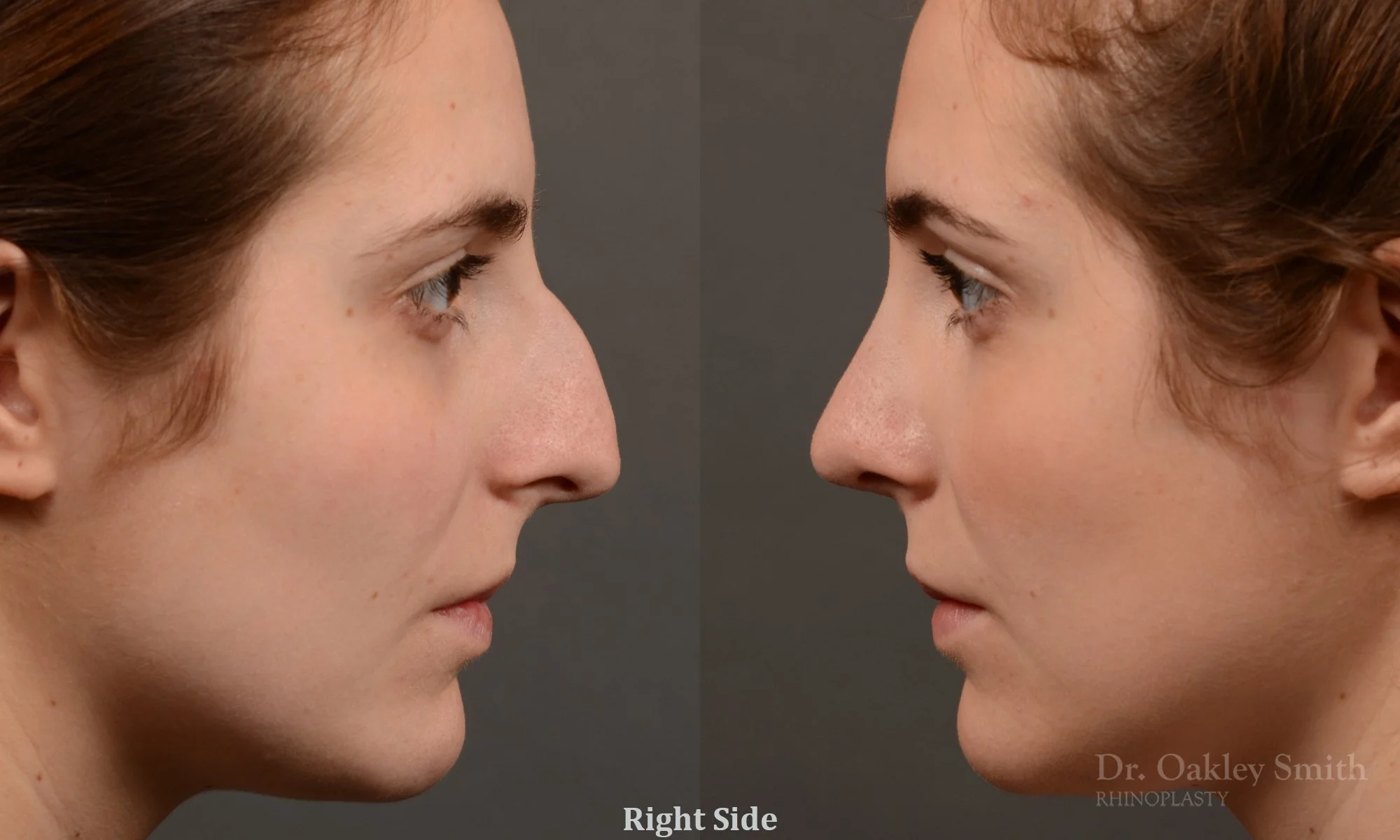 305.1C-rhinoplasty-dr-oakley-smith-toronto-nose-job.jpg