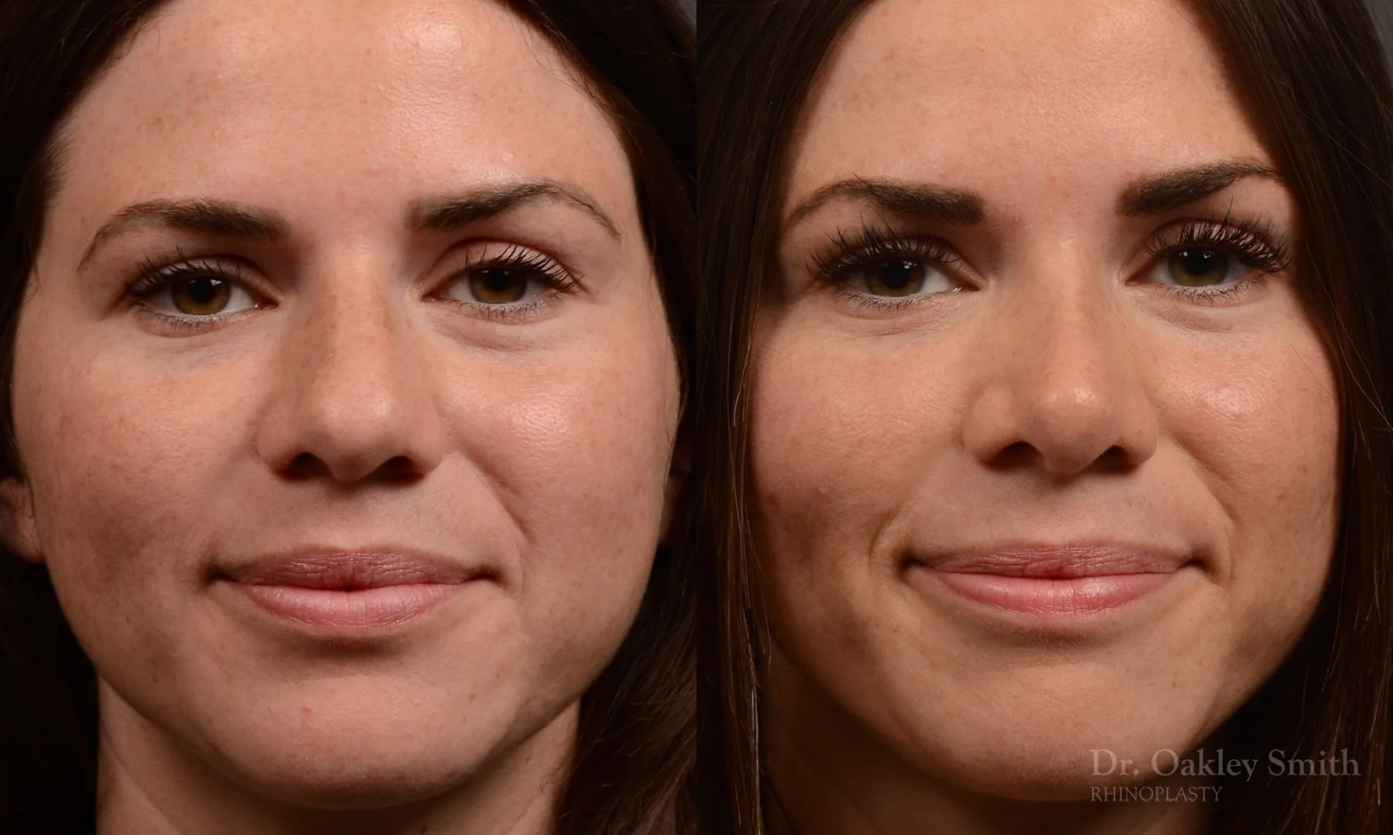481A-rhinoplasty-dr-oakley-smith-toronto-top-surgeon-nose-job.jpg